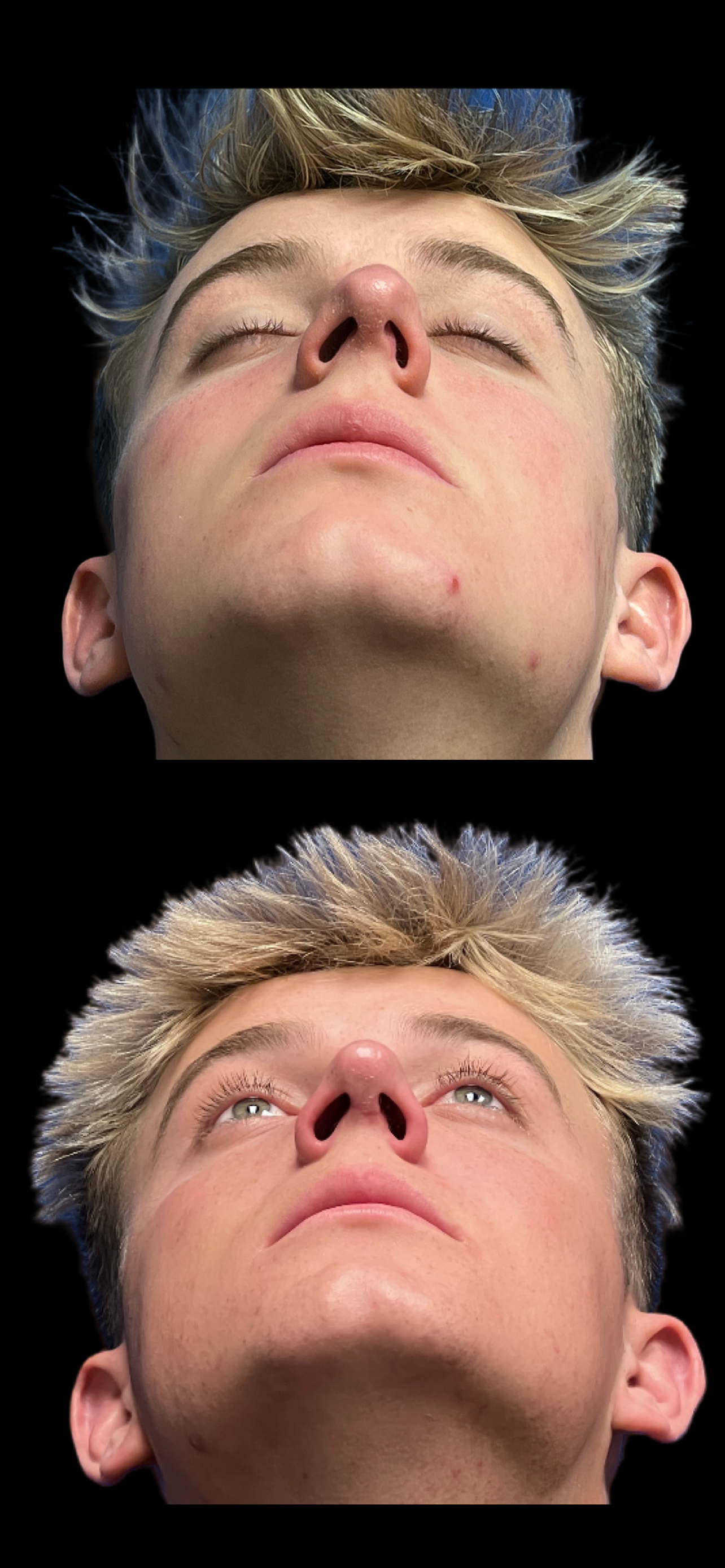 PEAK PLASTIC SURGERY rhinoplasty result — Draper, UT