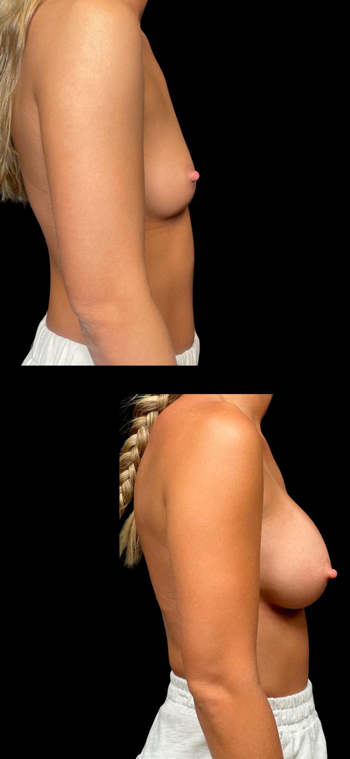 PEAK PLASTIC SURGERY breast augmentation result — Draper, UT