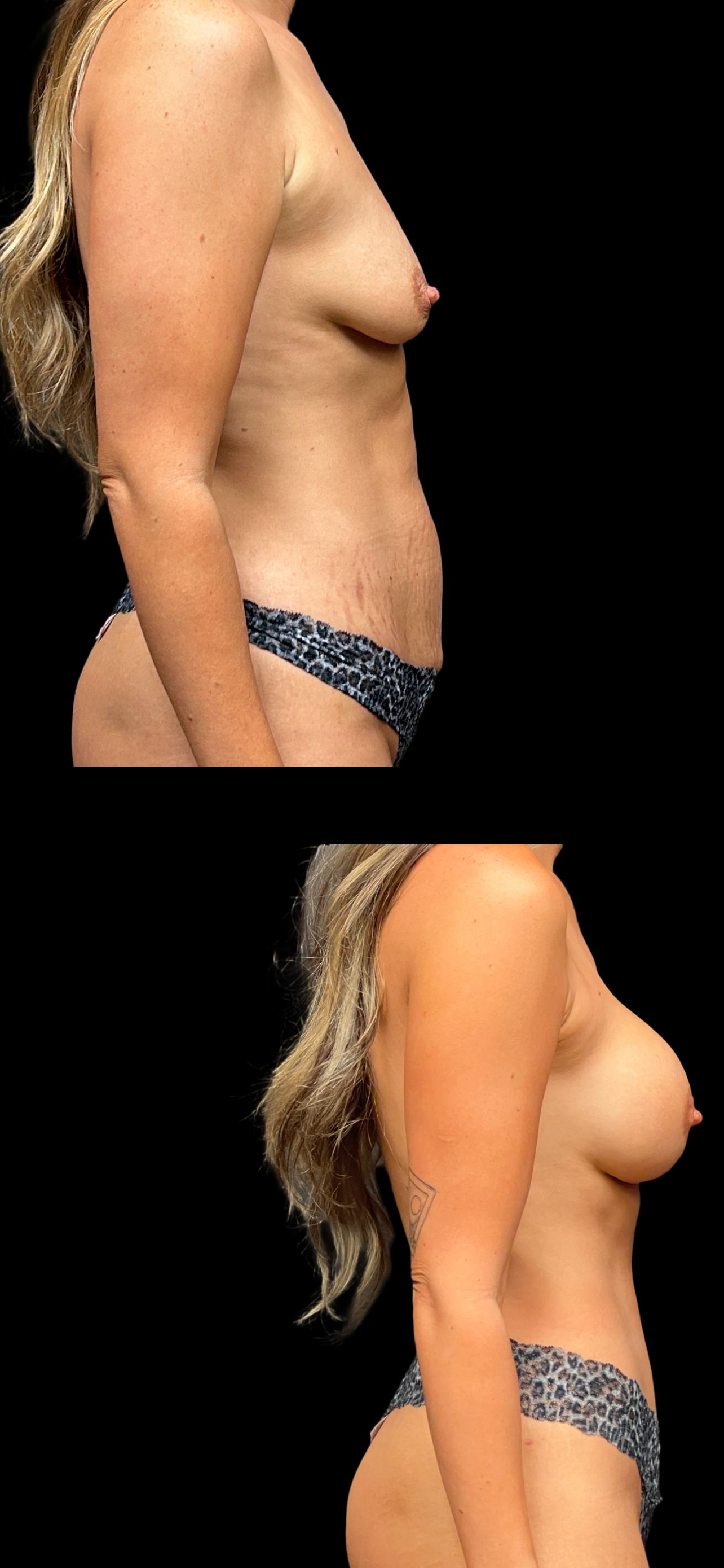 PEAK PLASTIC SURGERY mommy makeover result — Draper, UT