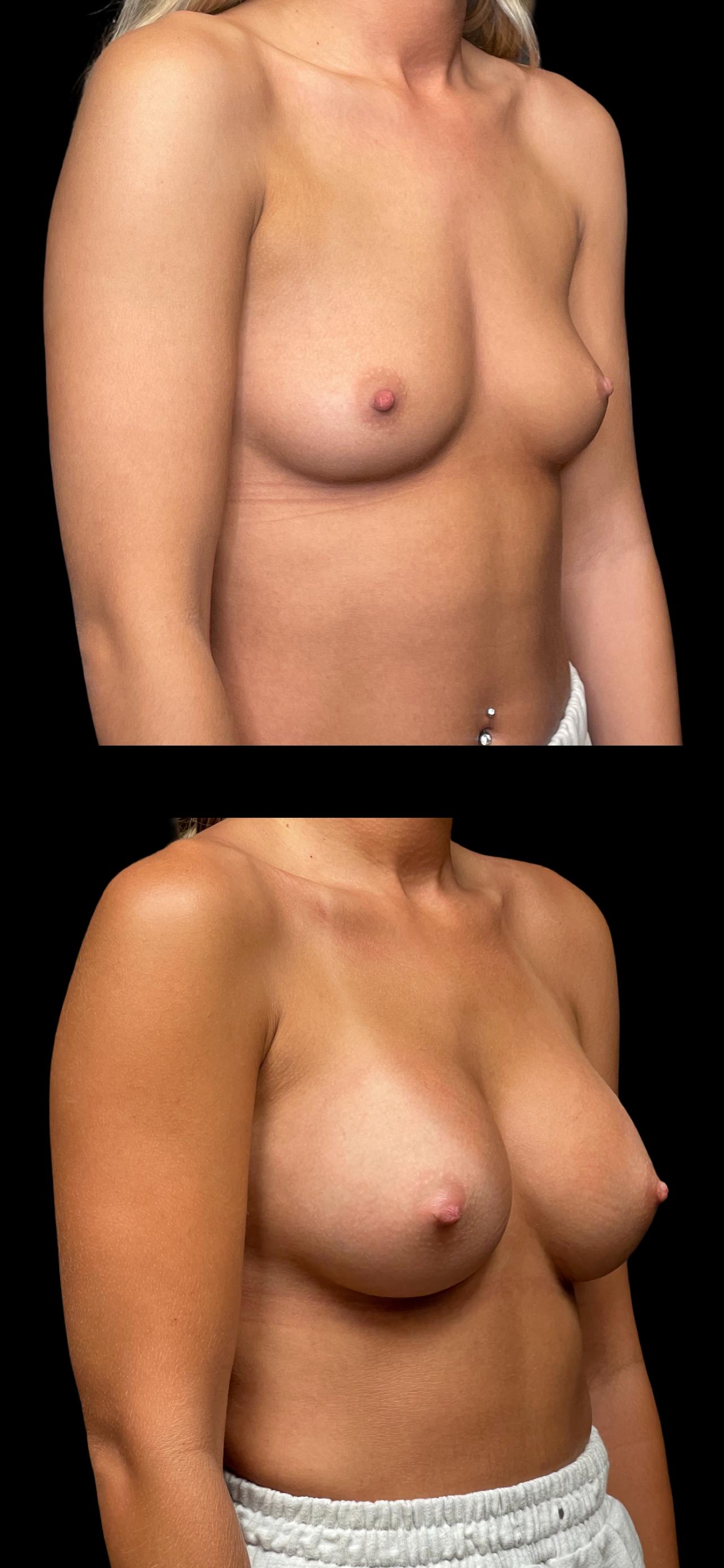 PEAK PLASTIC SURGERY breast augmentation result — Salt Lake City, UT