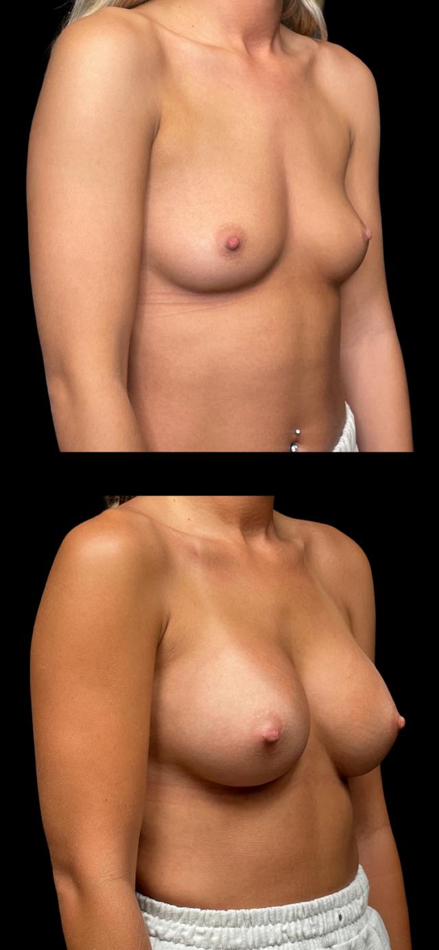 Breast Augmentation result at PEAK PLASTIC SURGERY in Salt Lake City, UT