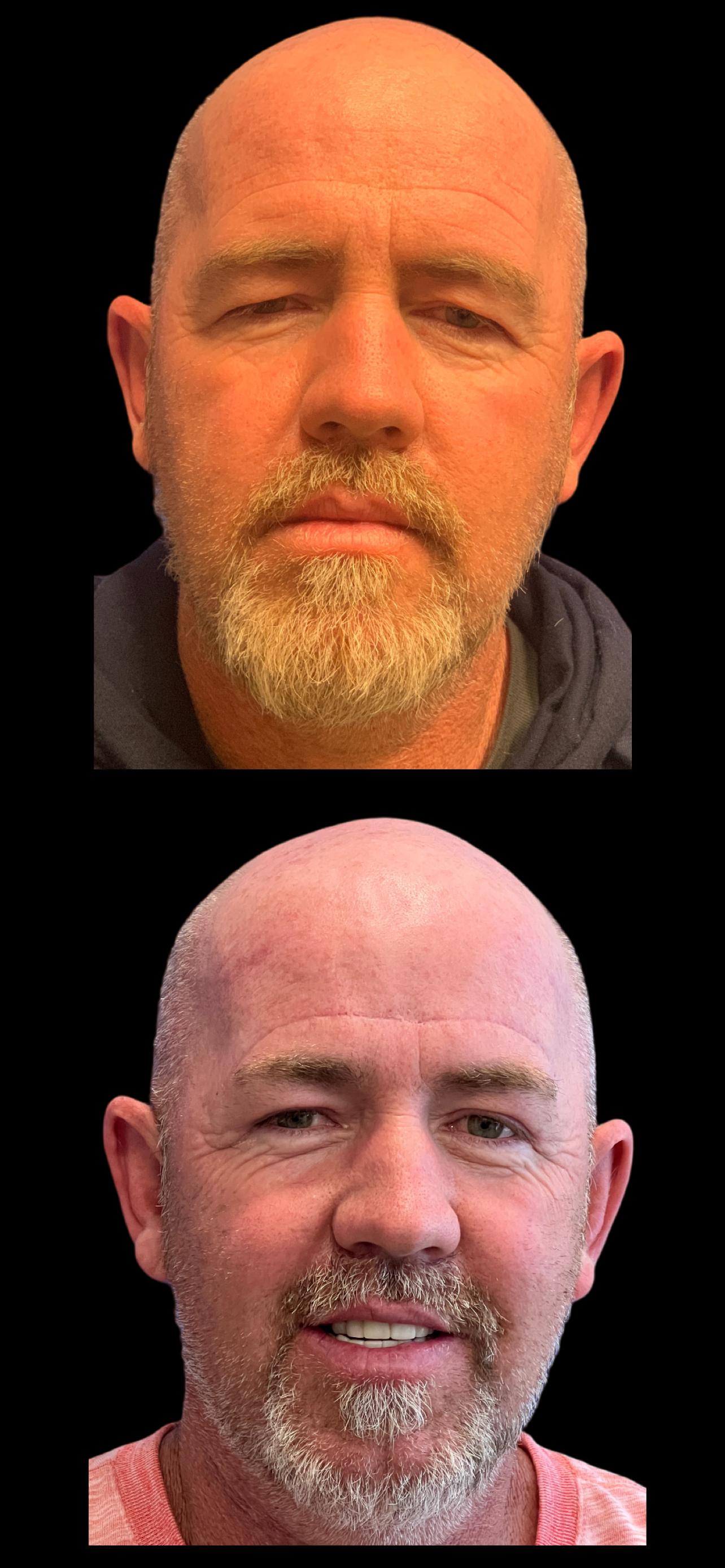 PEAK PLASTIC SURGERY brow lift result — Draper, UT
