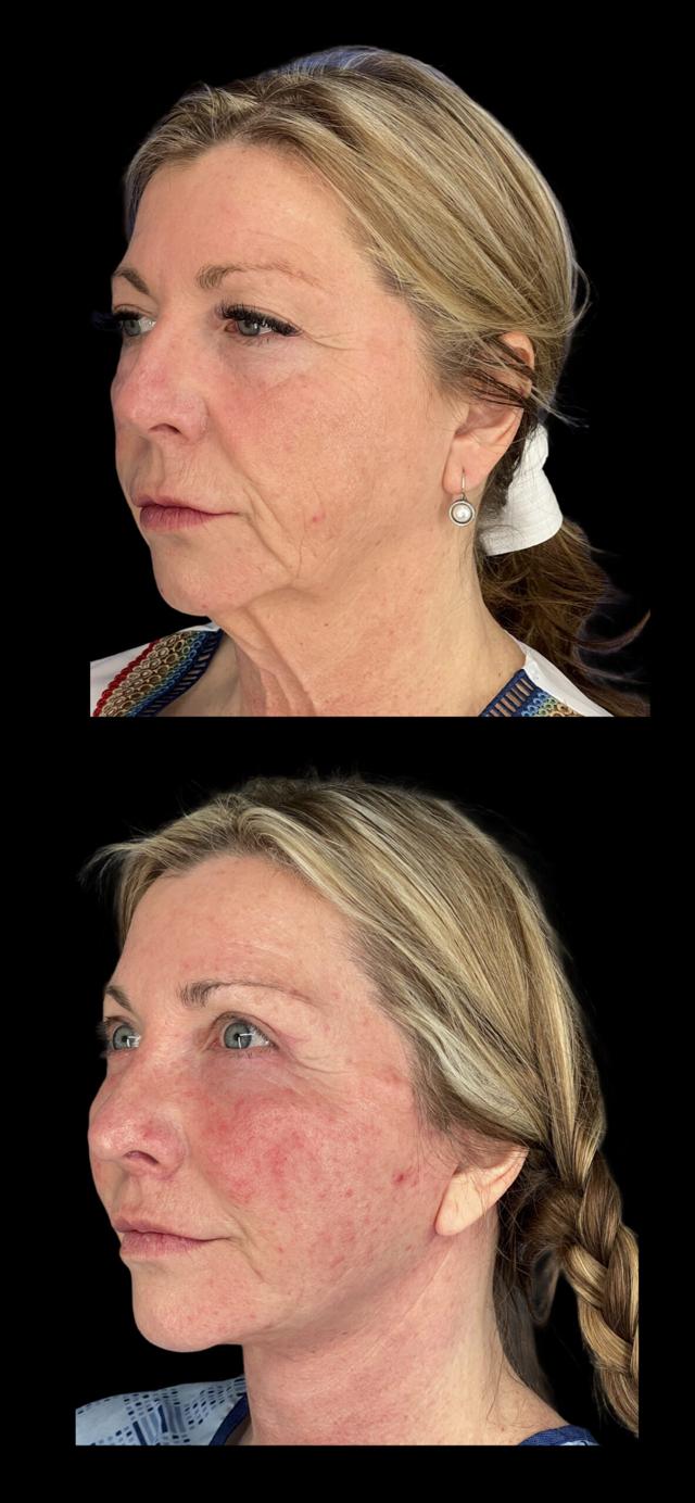 Neck Lift result at PEAK PLASTIC SURGERY in Draper, UT