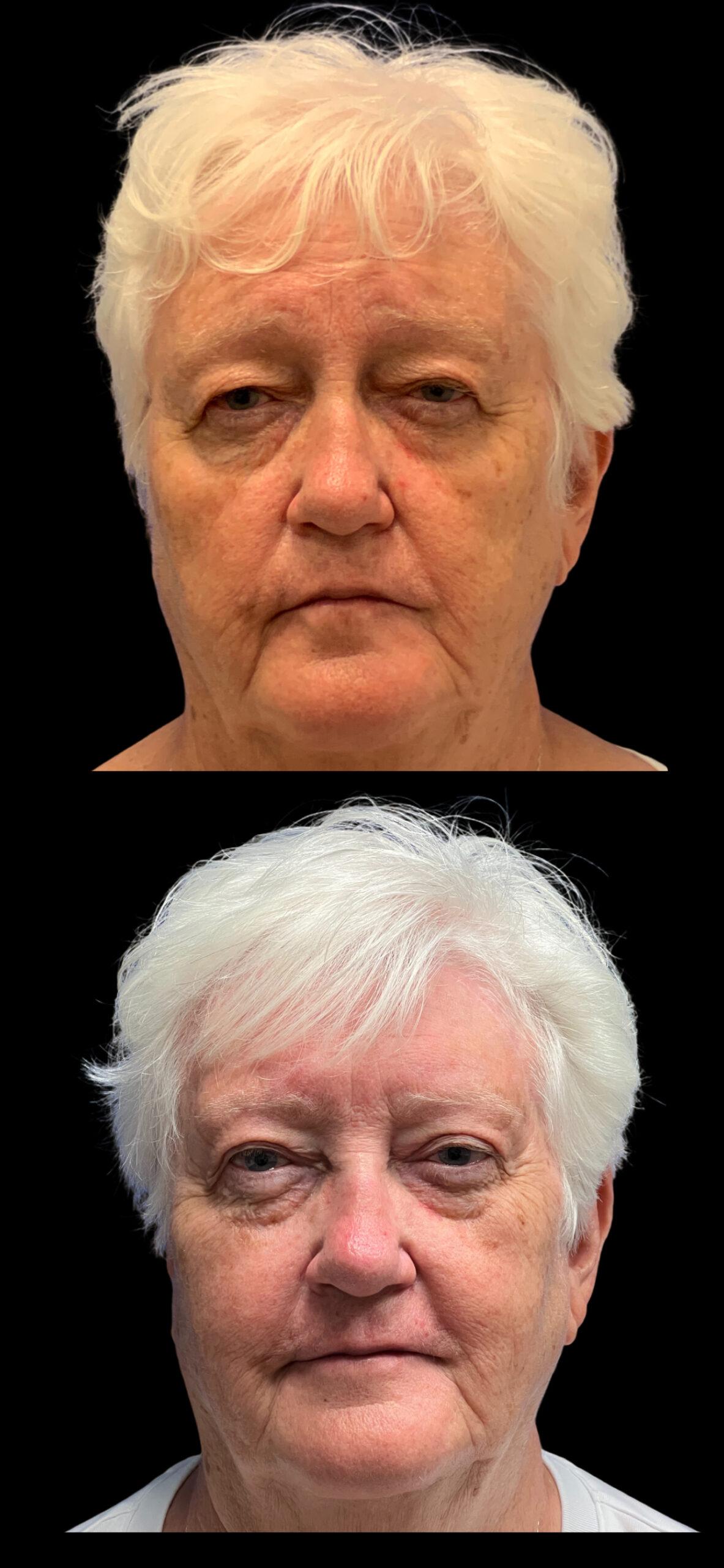 PEAK PLASTIC SURGERY brow lift result — Draper, UT