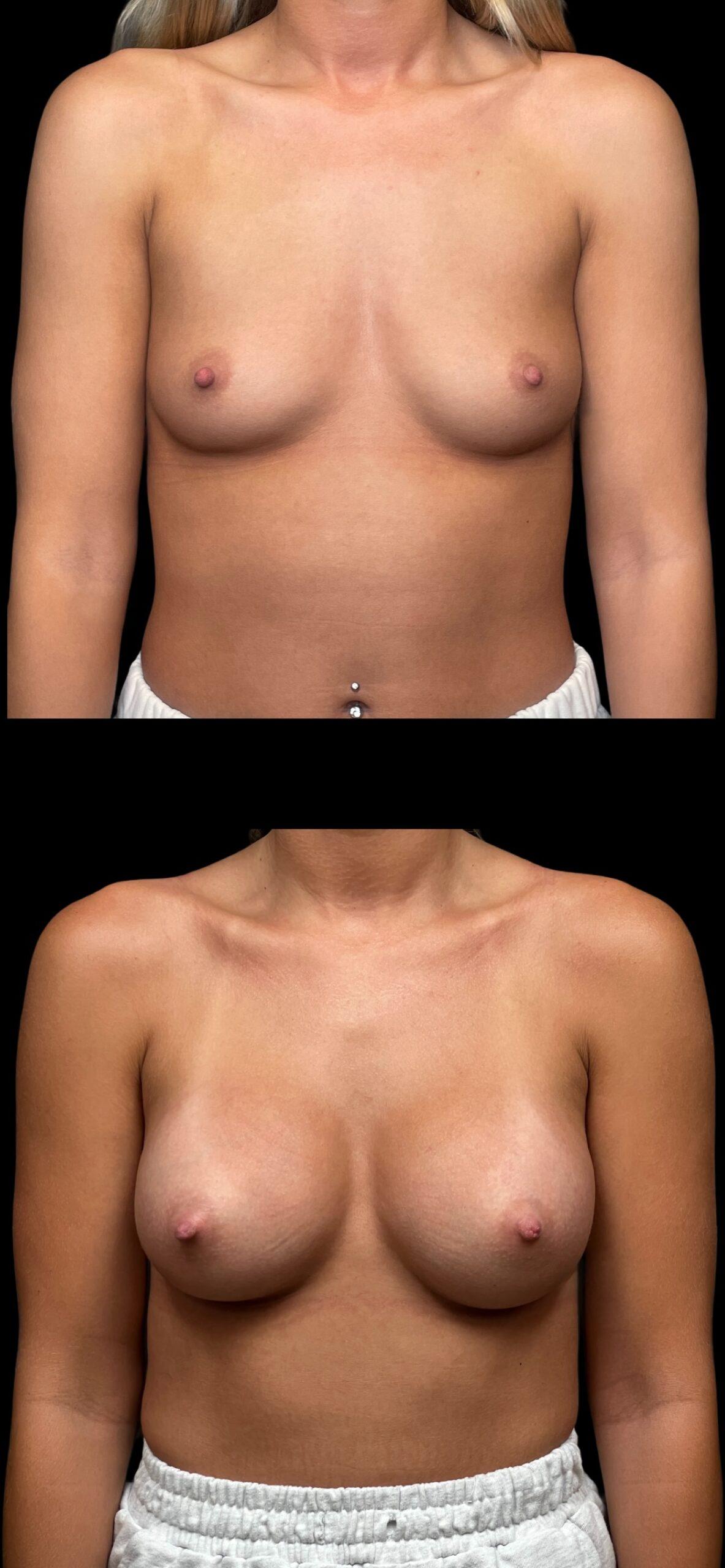 PEAK PLASTIC SURGERY breast augmentation result — Draper, UT