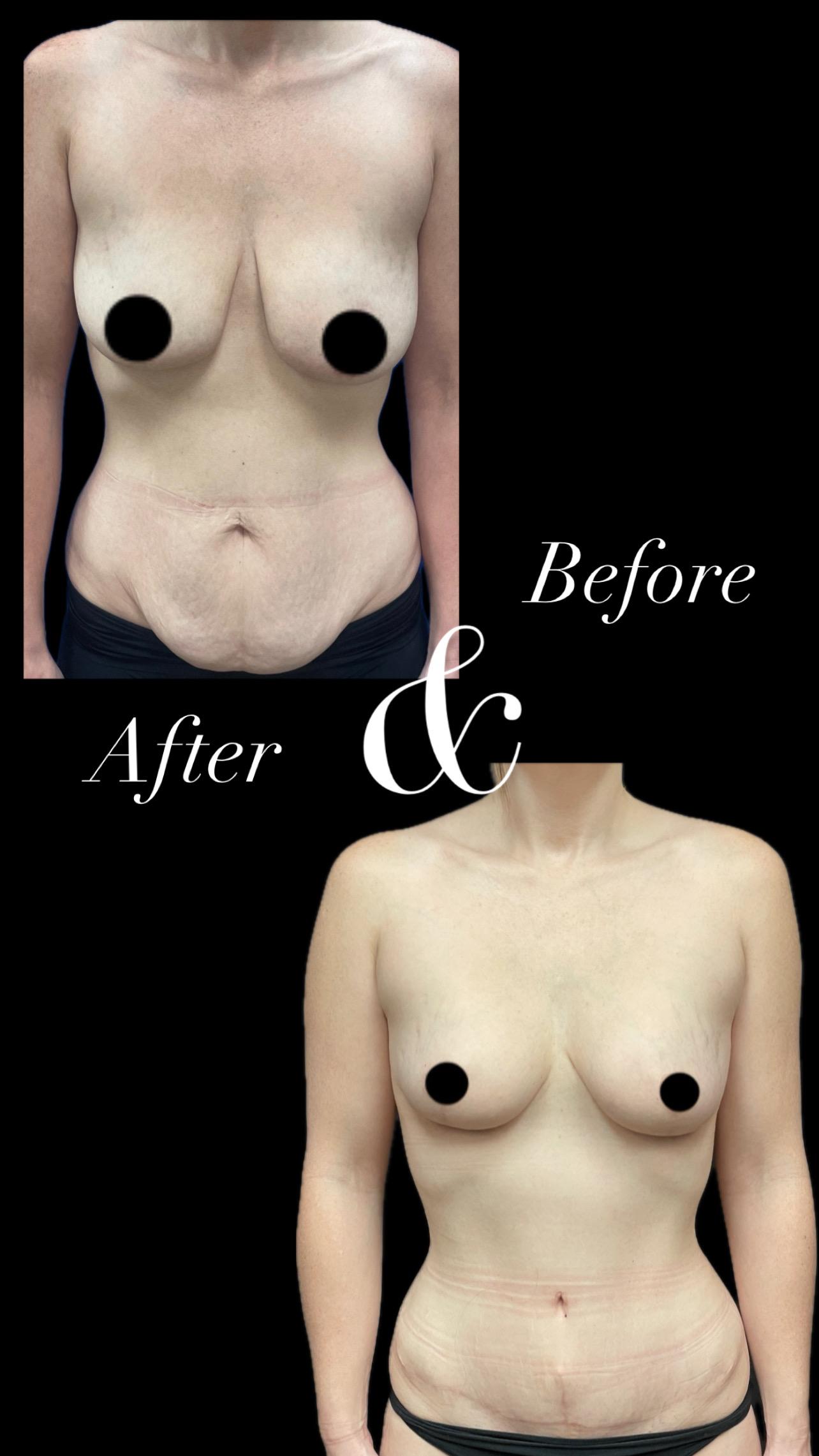 PEAK PLASTIC SURGERY tummy tuck result — Salt Lake City, UT