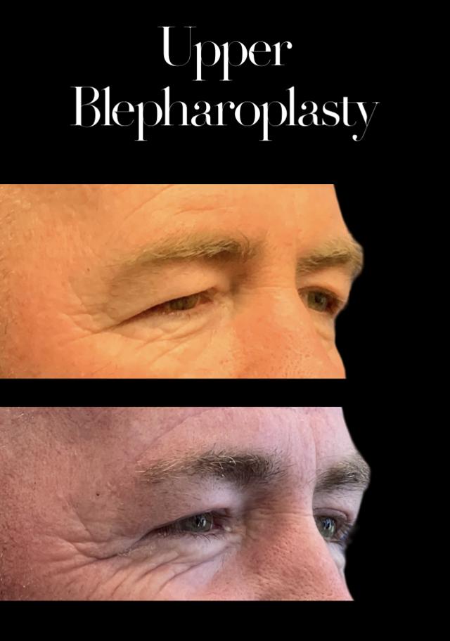 Blepharoplasty result at PEAK PLASTIC SURGERY in Salt Lake City, UT