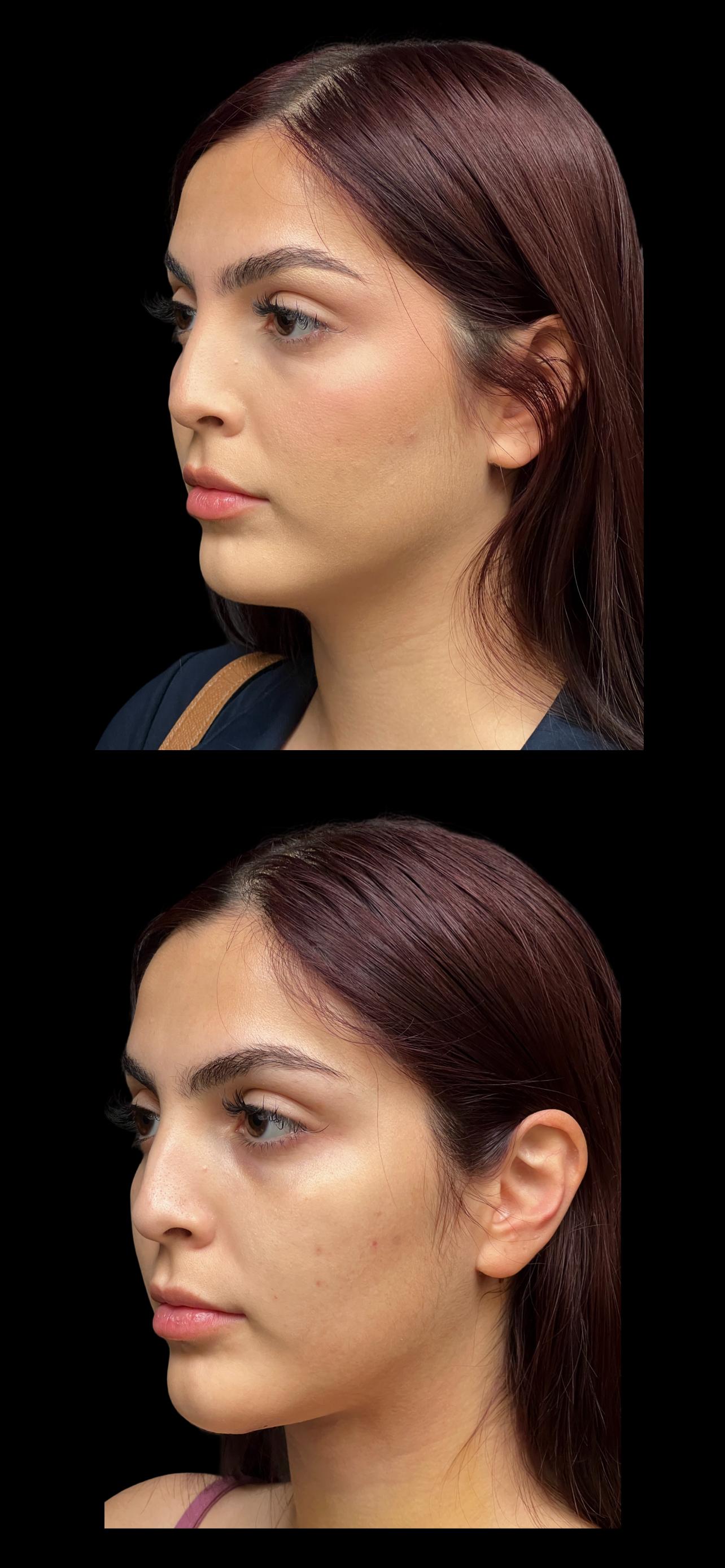 PEAK PLASTIC SURGERY neck lift result — Draper, UT