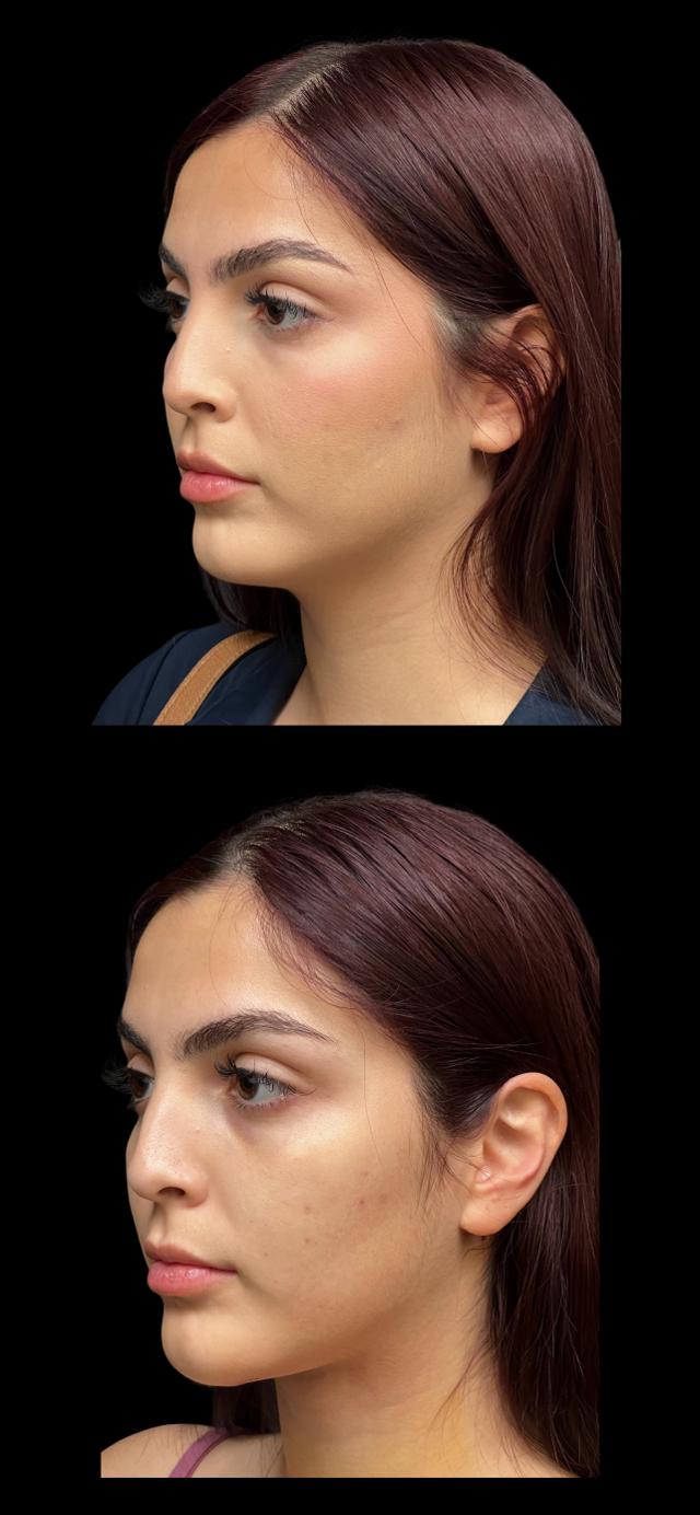 Neck Lift result at PEAK PLASTIC SURGERY in Salt Lake City, UT
