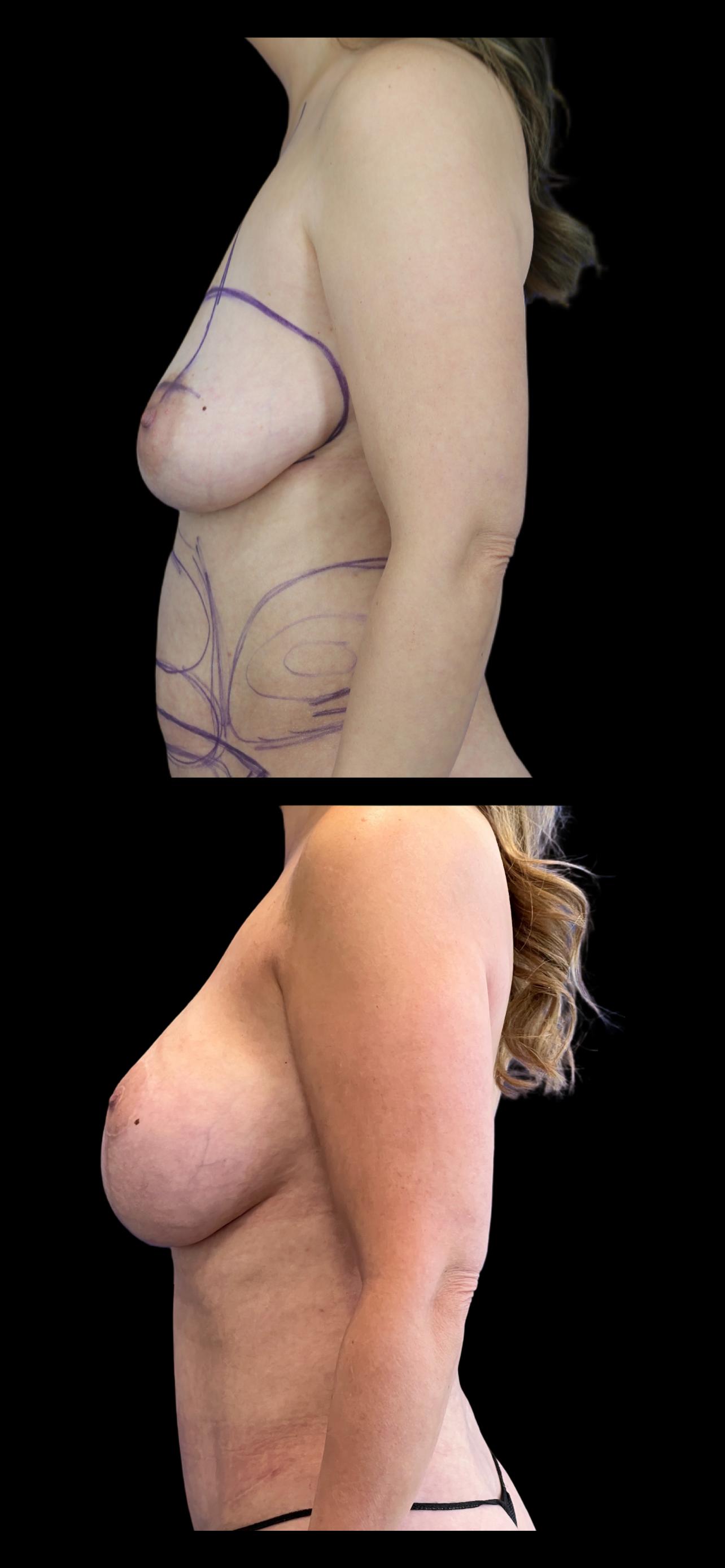 PEAK PLASTIC SURGERY breast lift result — Draper, UT
