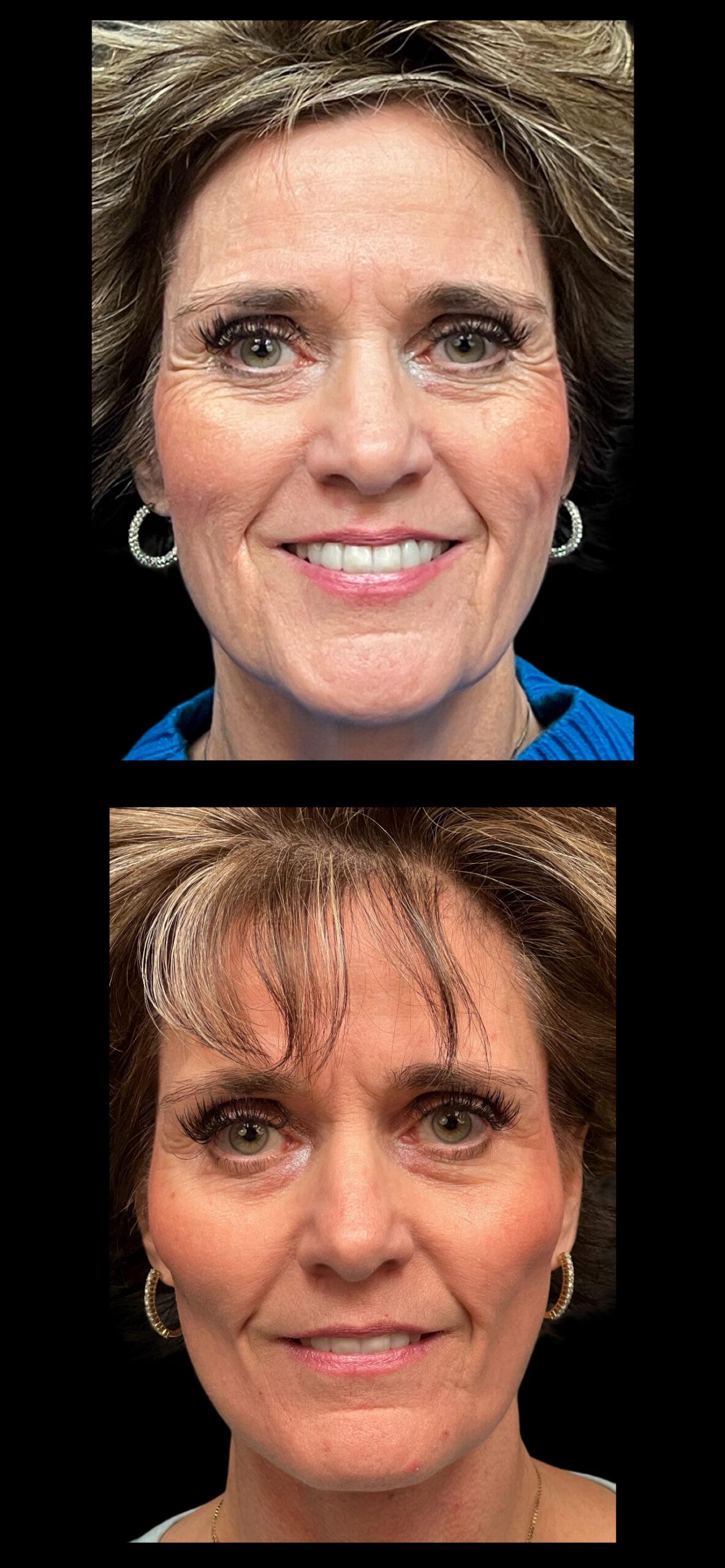 PEAK PLASTIC SURGERY facelift result — Draper, UT