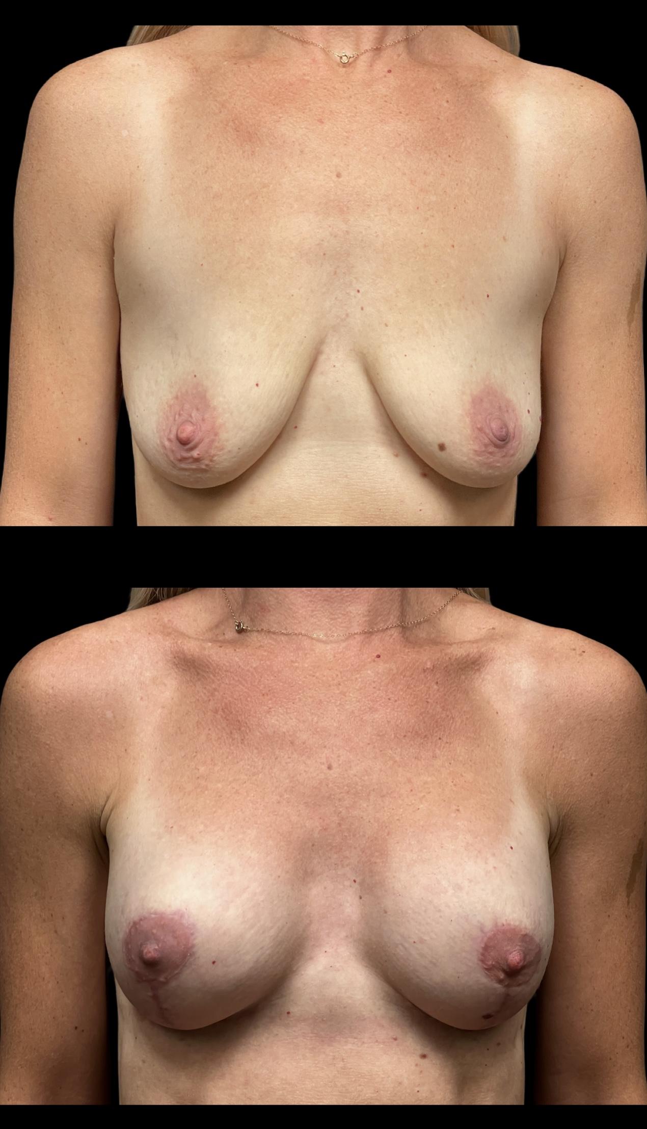PEAK PLASTIC SURGERY breast lift result — Draper, UT