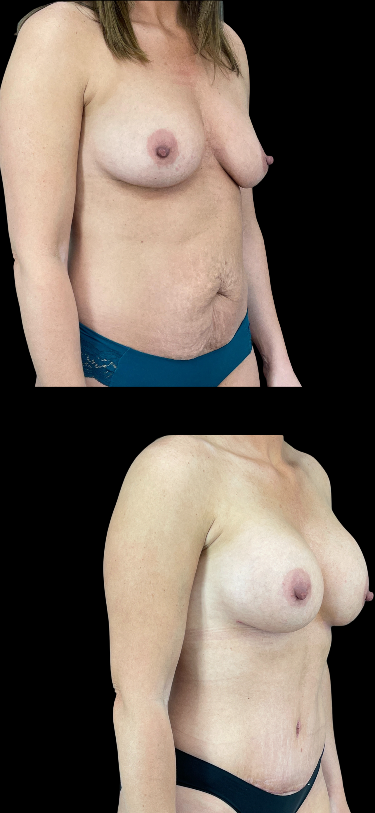 PEAK PLASTIC SURGERY mommy makeover result — Draper, UT