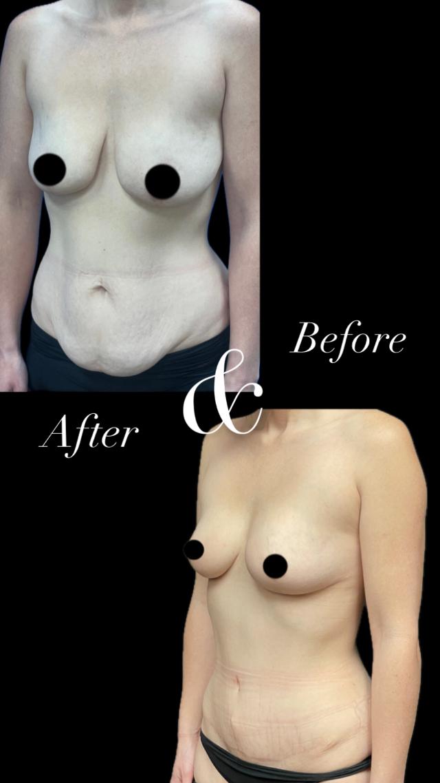Tummy Tuck result at PEAK PLASTIC SURGERY in Salt Lake City, UT