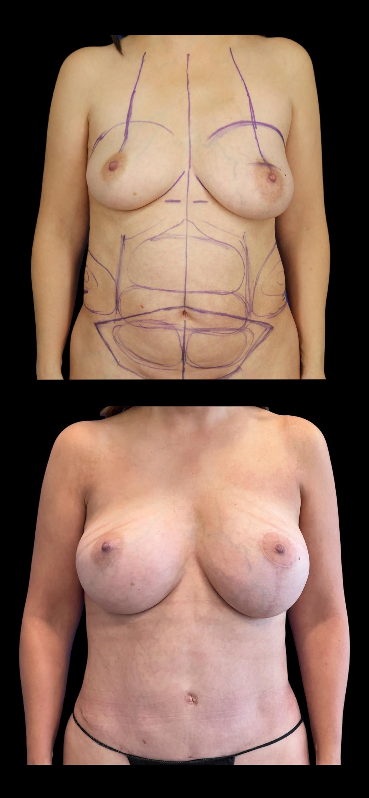 PEAK PLASTIC SURGERY breast lift result — Draper, UT