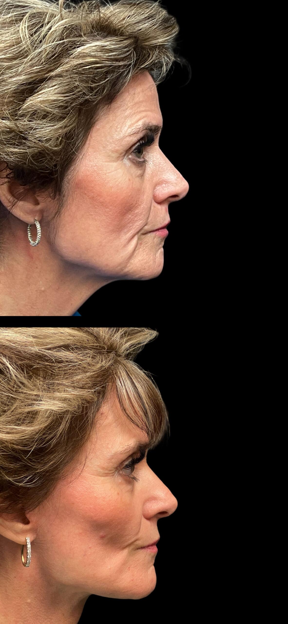 PEAK PLASTIC SURGERY facelift result — Draper, UT