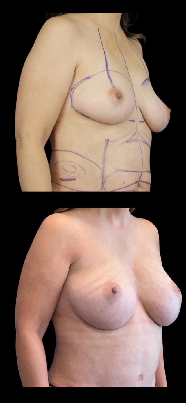 Breast Lift result at PEAK PLASTIC SURGERY in Salt Lake City, UT