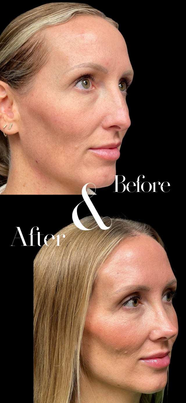 Functional Rhinoplasty result at PEAK PLASTIC SURGERY in Draper, UT