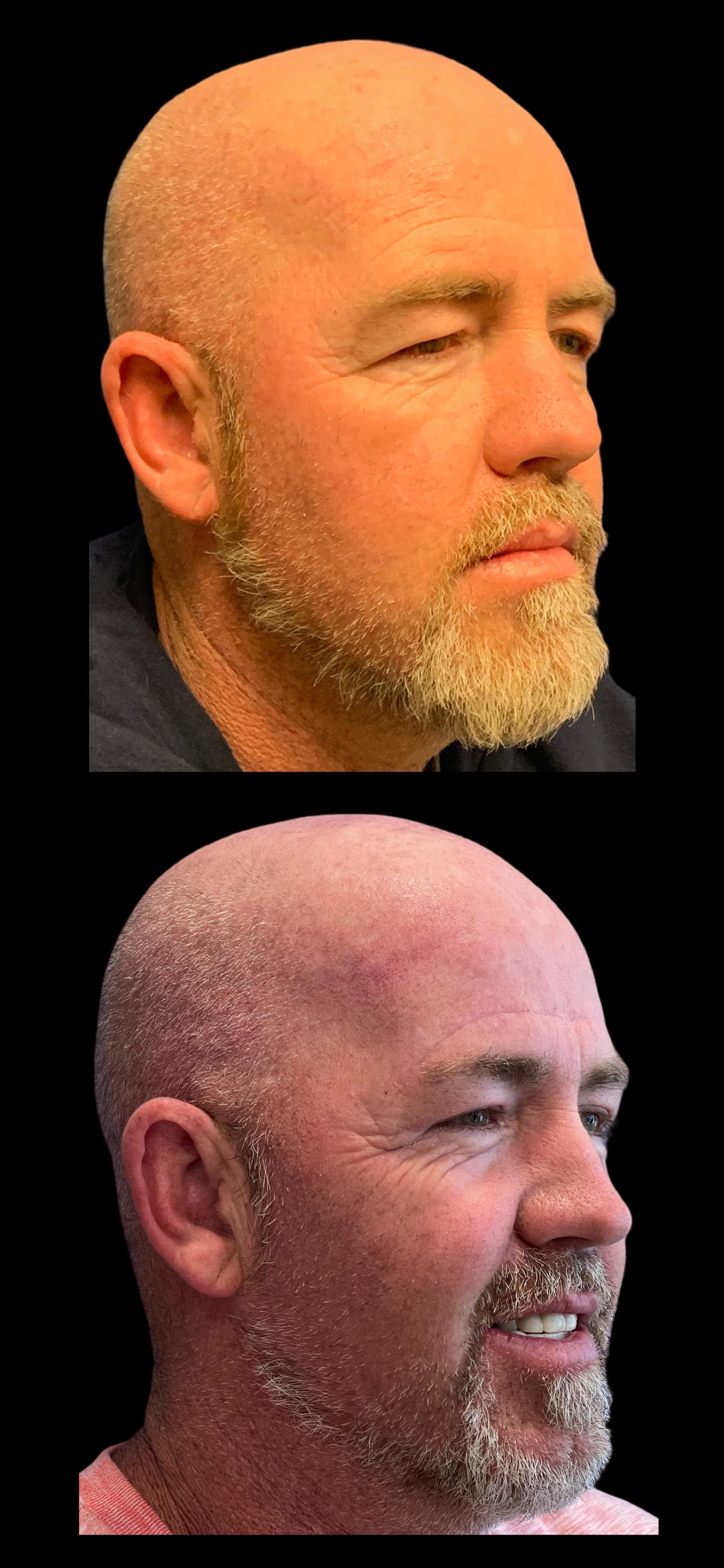 PEAK PLASTIC SURGERY brow lift result — Draper, UT