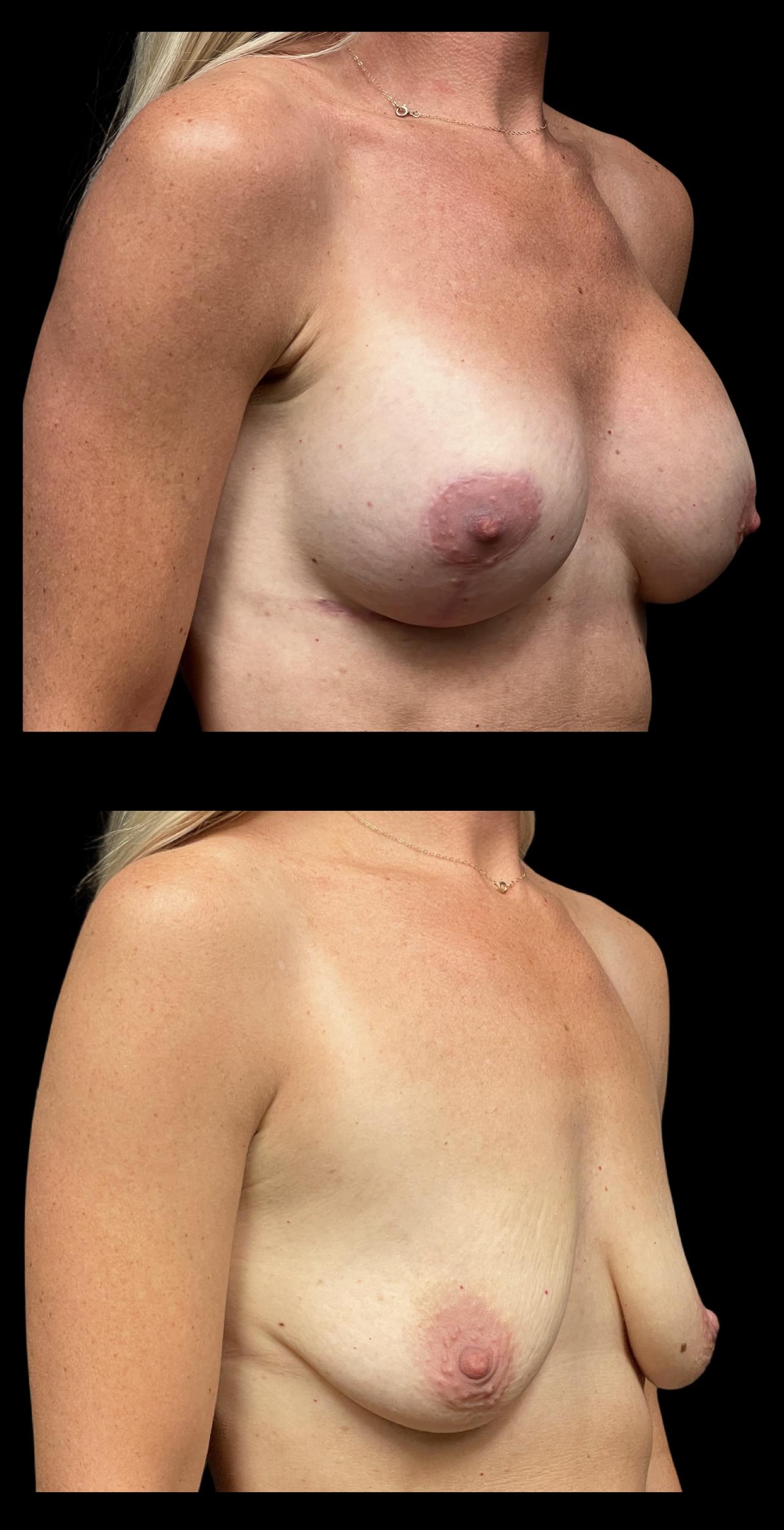 PEAK PLASTIC SURGERY breast lift result — Draper, UT