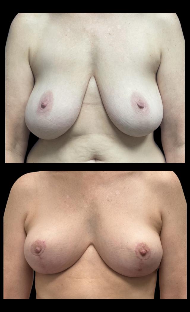 Breast Reduction result at PEAK PLASTIC SURGERY in Salt Lake City, UT