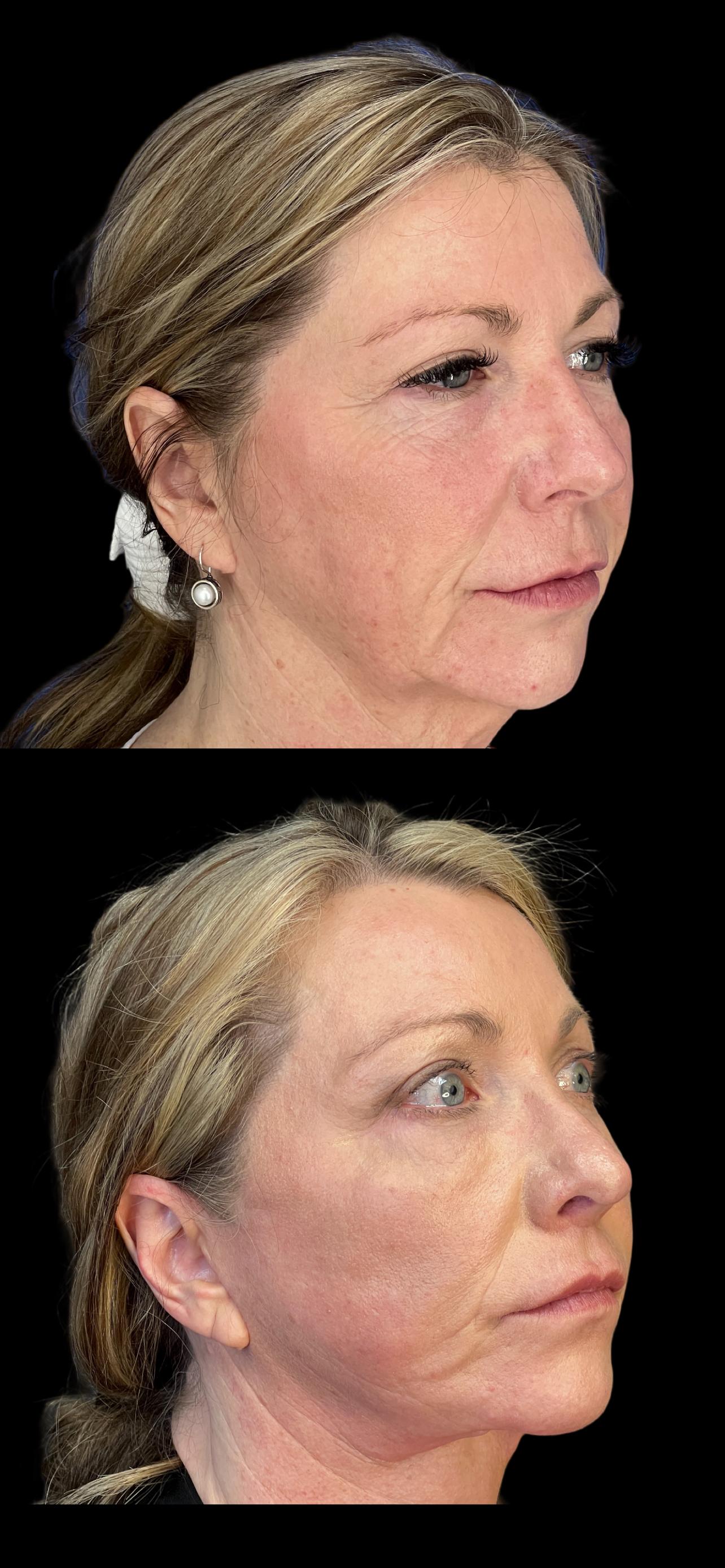 PEAK PLASTIC SURGERY facelift result — Draper, UT