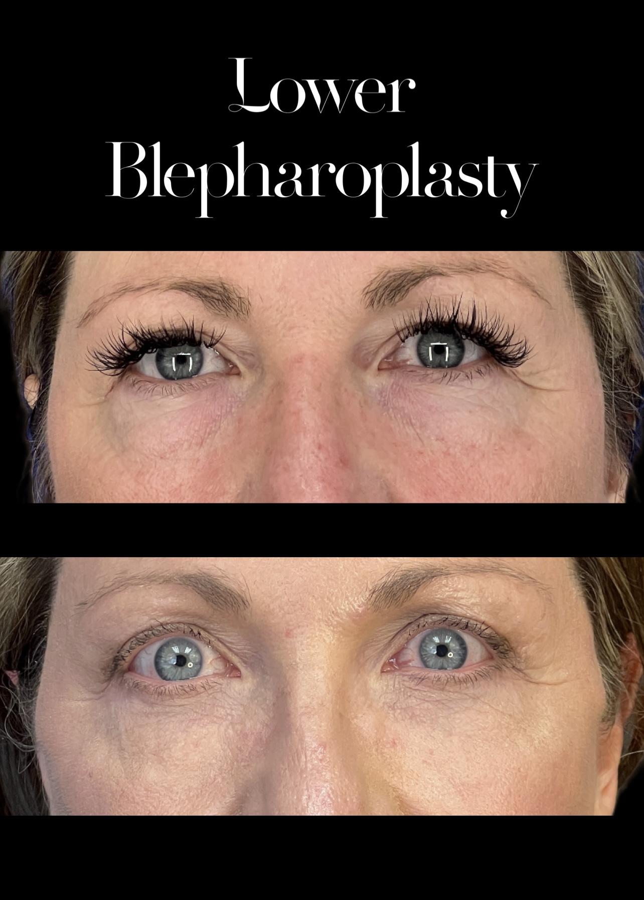 PEAK PLASTIC SURGERY blepharoplasty result — Draper, UT