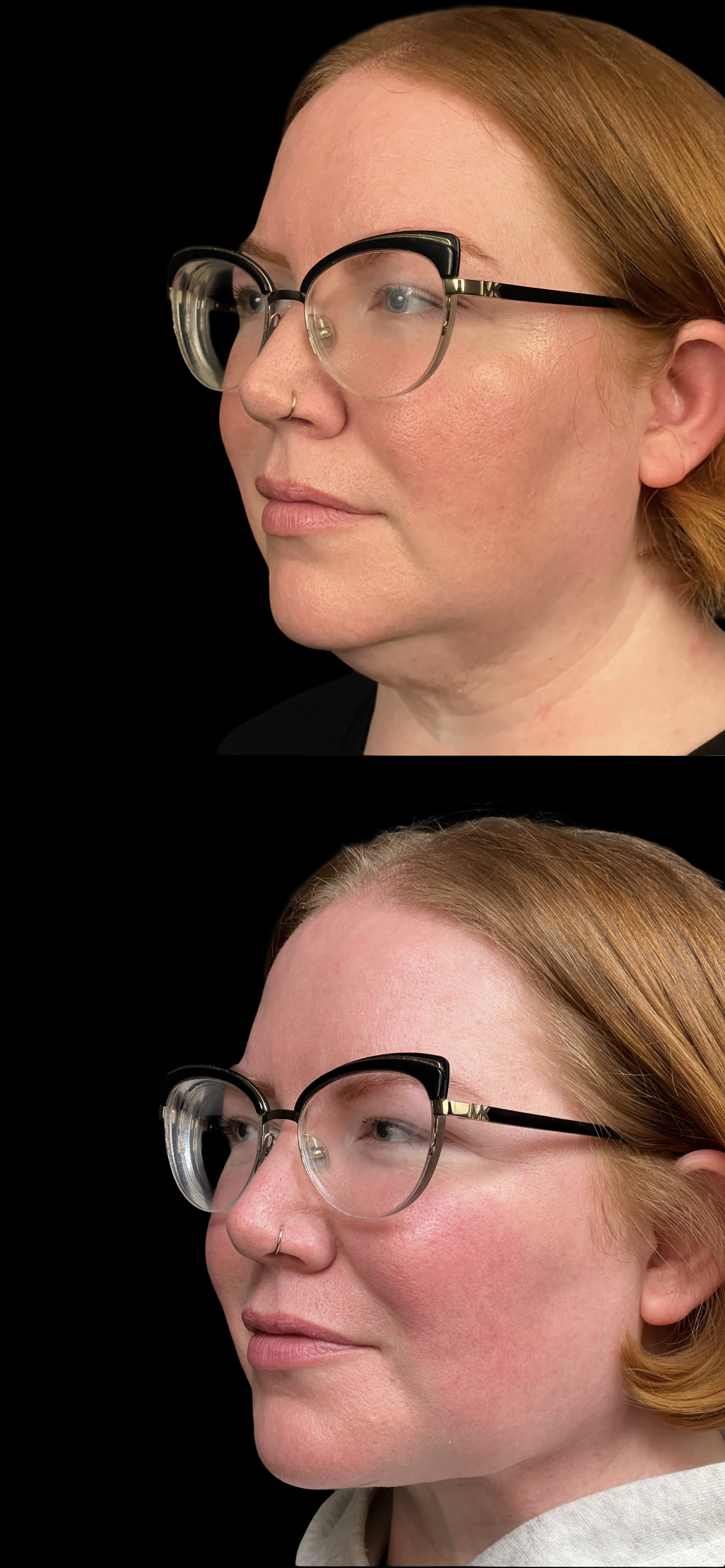 PEAK PLASTIC SURGERY neck lift result — Draper, UT