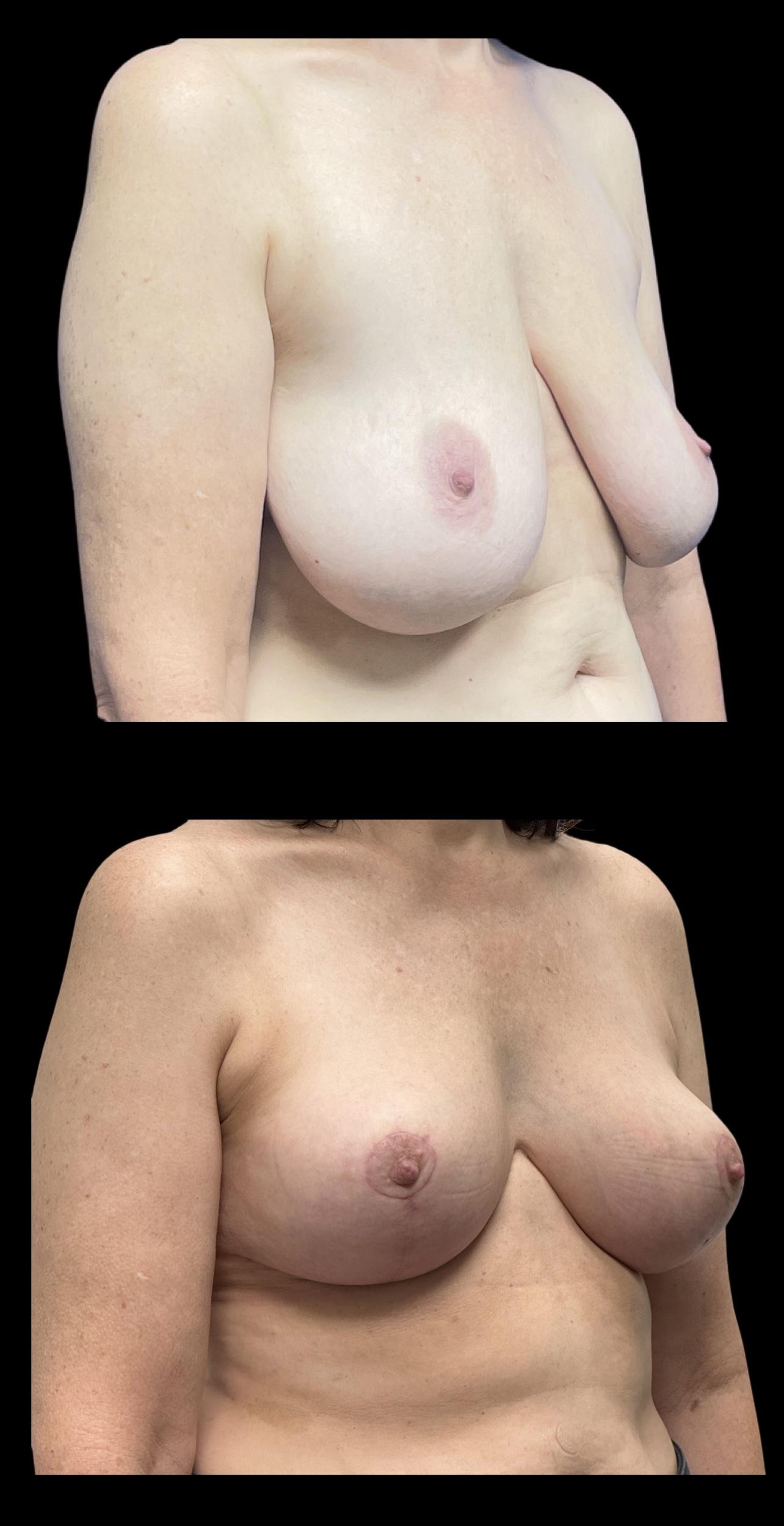 PEAK PLASTIC SURGERY breast reduction result — Draper, UT