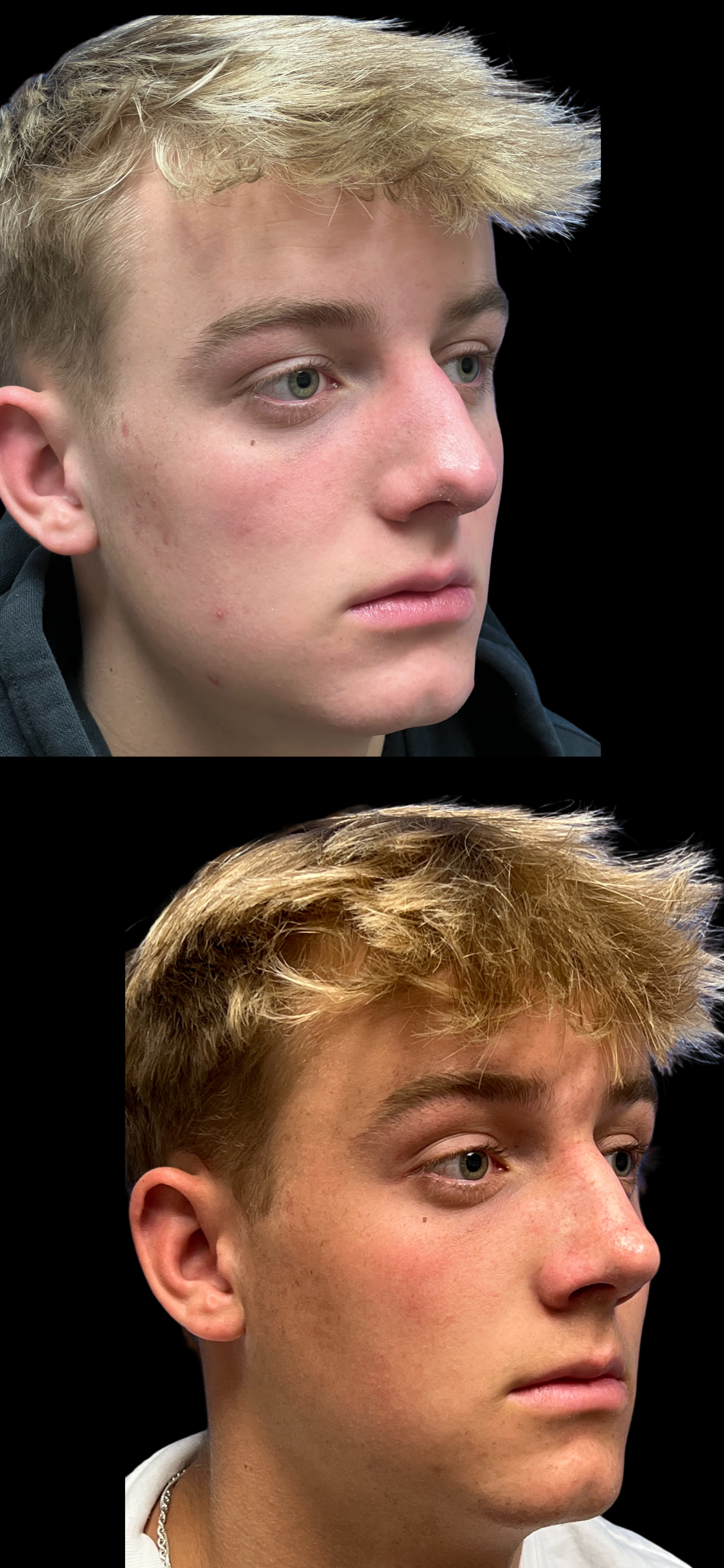 PEAK PLASTIC SURGERY rhinoplasty result — Draper, UT