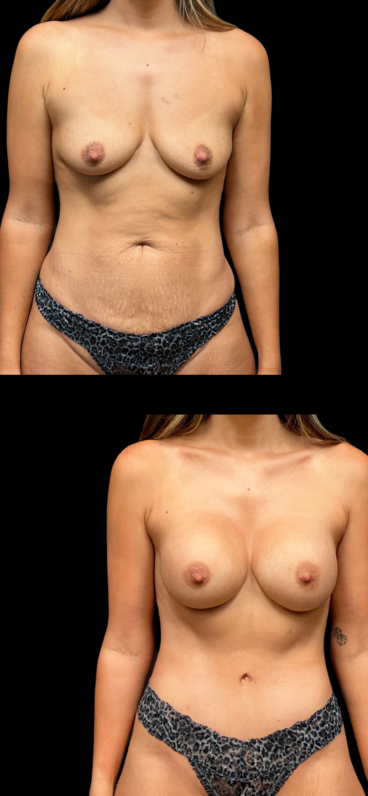 PEAK PLASTIC SURGERY mommy makeover result — Draper, UT