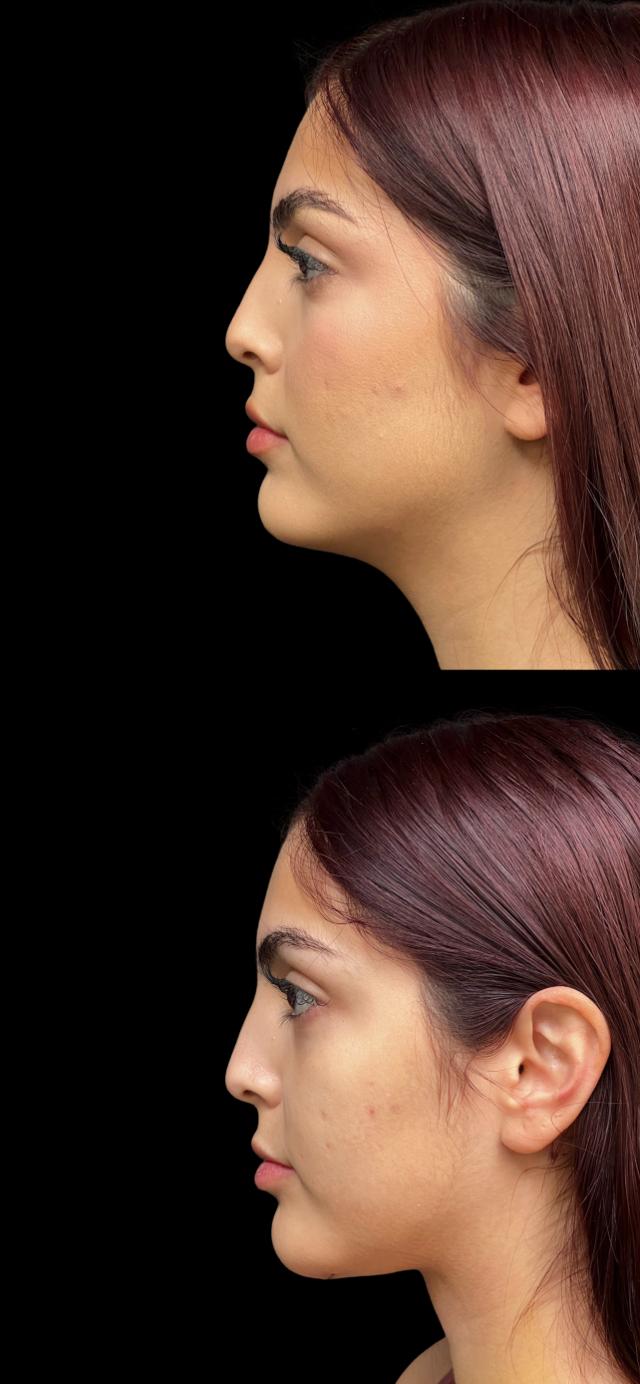 Neck Lift result at PEAK PLASTIC SURGERY in Salt Lake City, UT