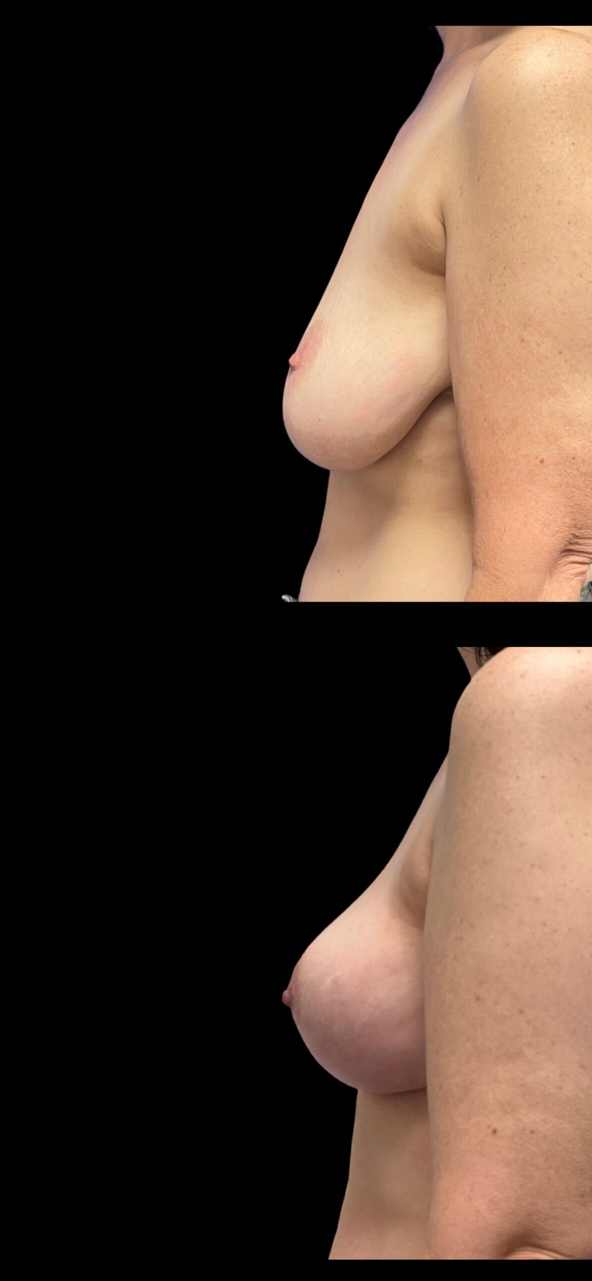 PEAK PLASTIC SURGERY breast augmentation result — Draper, UT