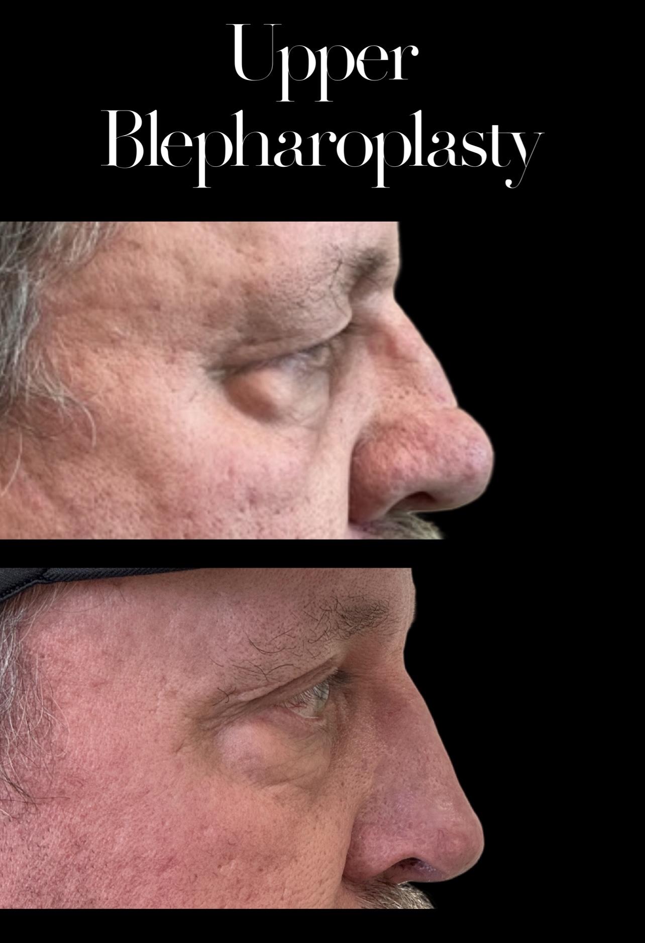 PEAK PLASTIC SURGERY blepharoplasty result — Draper, UT