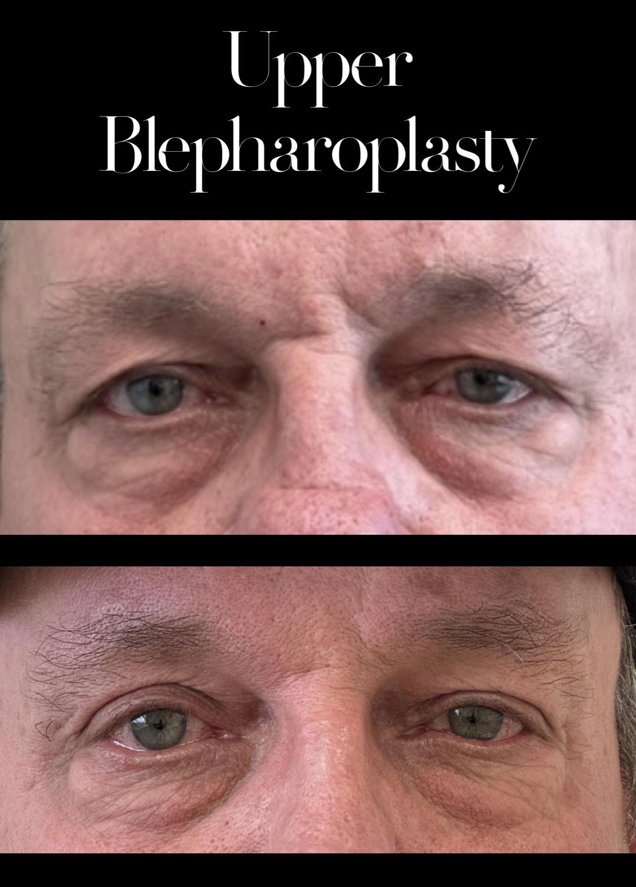 PEAK PLASTIC SURGERY blepharoplasty result — Draper, UT
