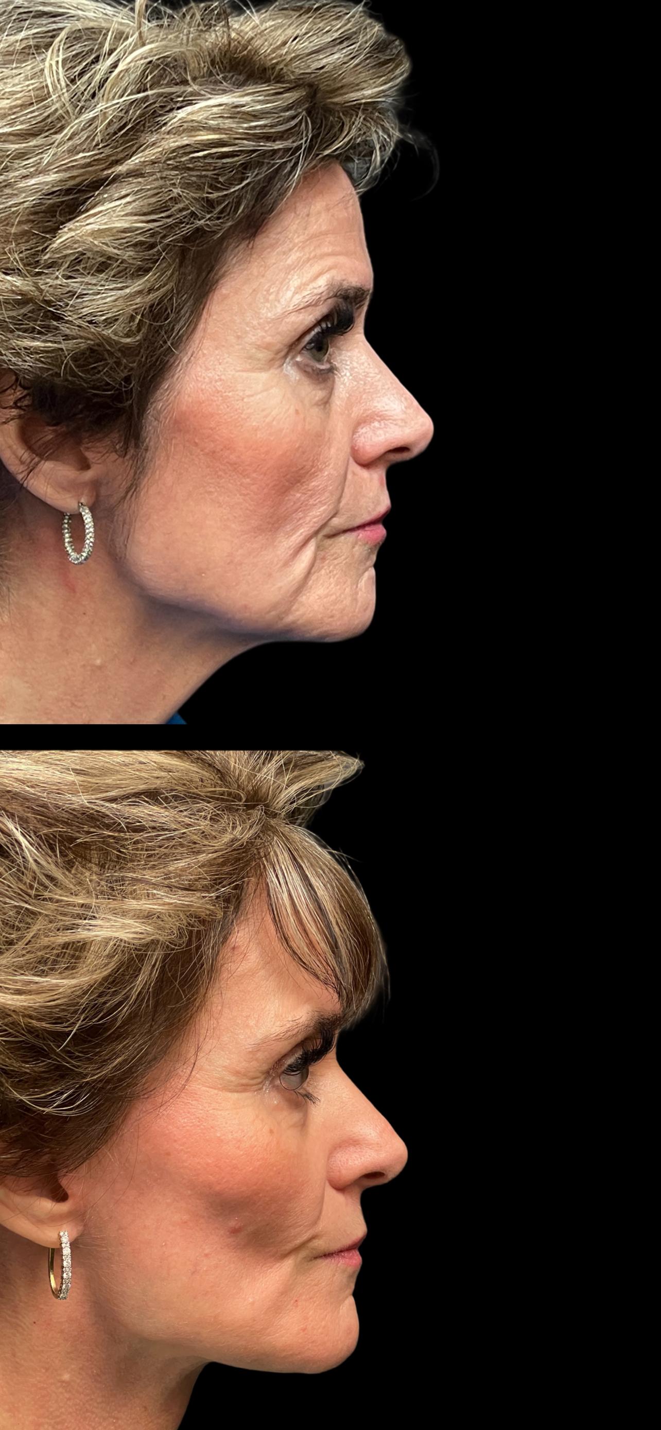 PEAK PLASTIC SURGERY facelift result — Draper, UT