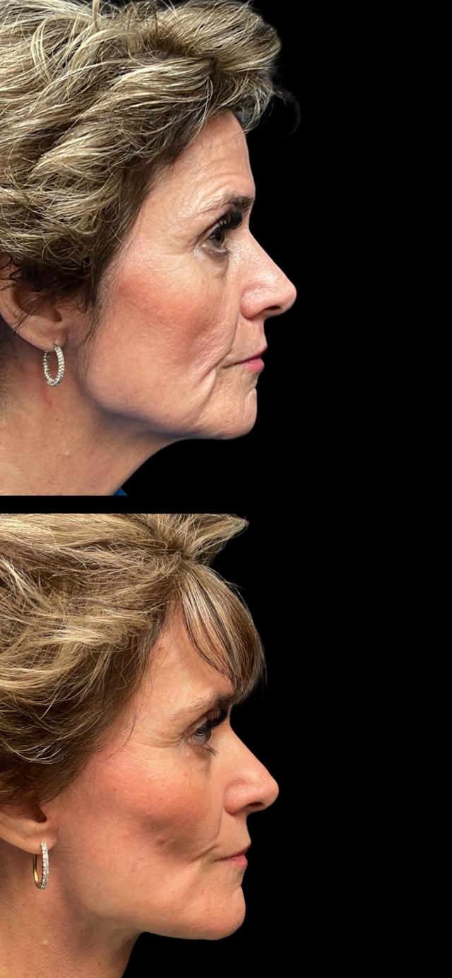 Deep Plane Facelift result at PEAK PLASTIC SURGERY in Salt Lake City, UT