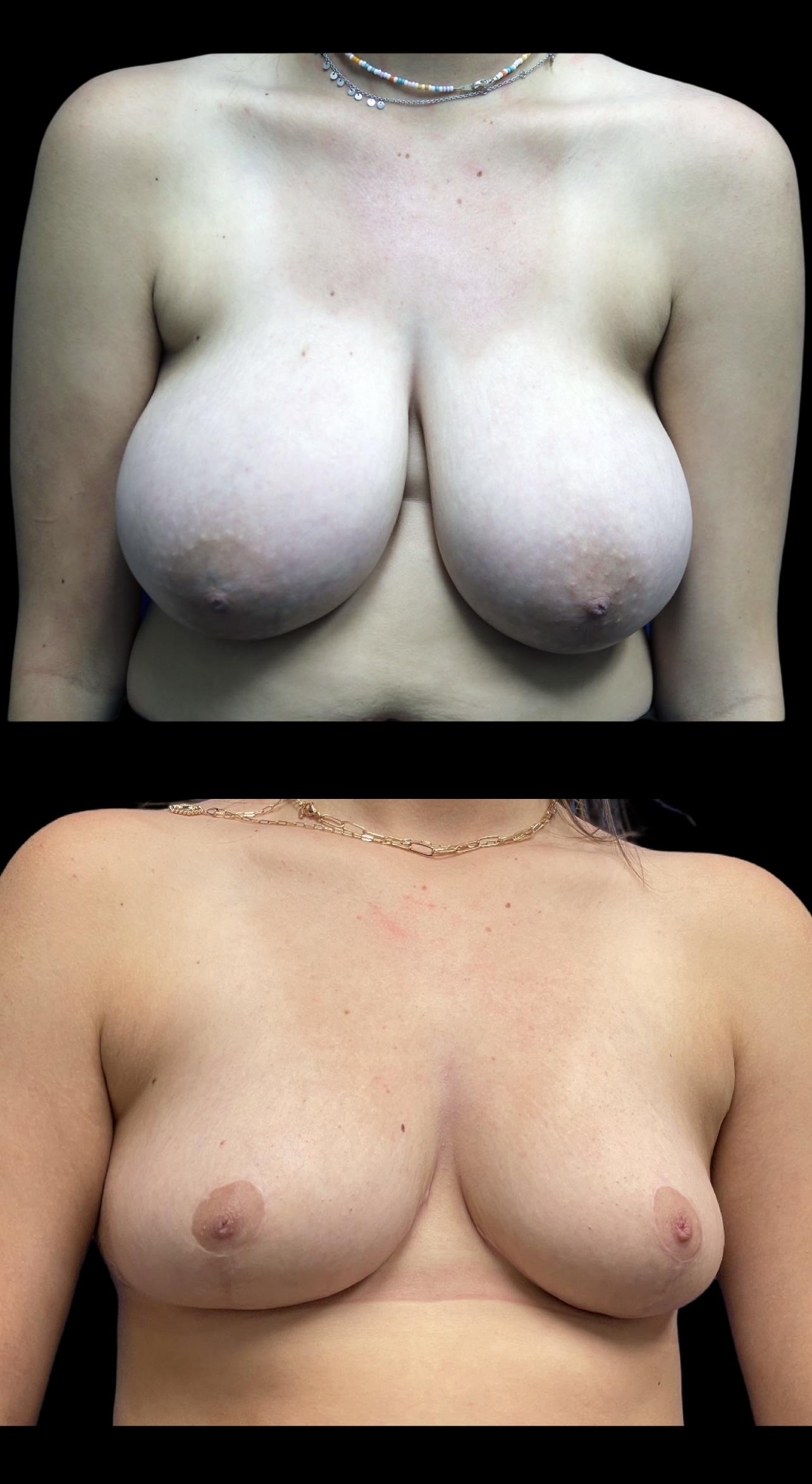 PEAK PLASTIC SURGERY breast reduction result — Draper, UT