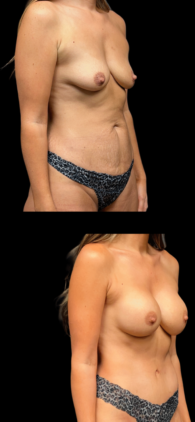Mommy Makeover result at PEAK PLASTIC SURGERY in Salt Lake City, UT