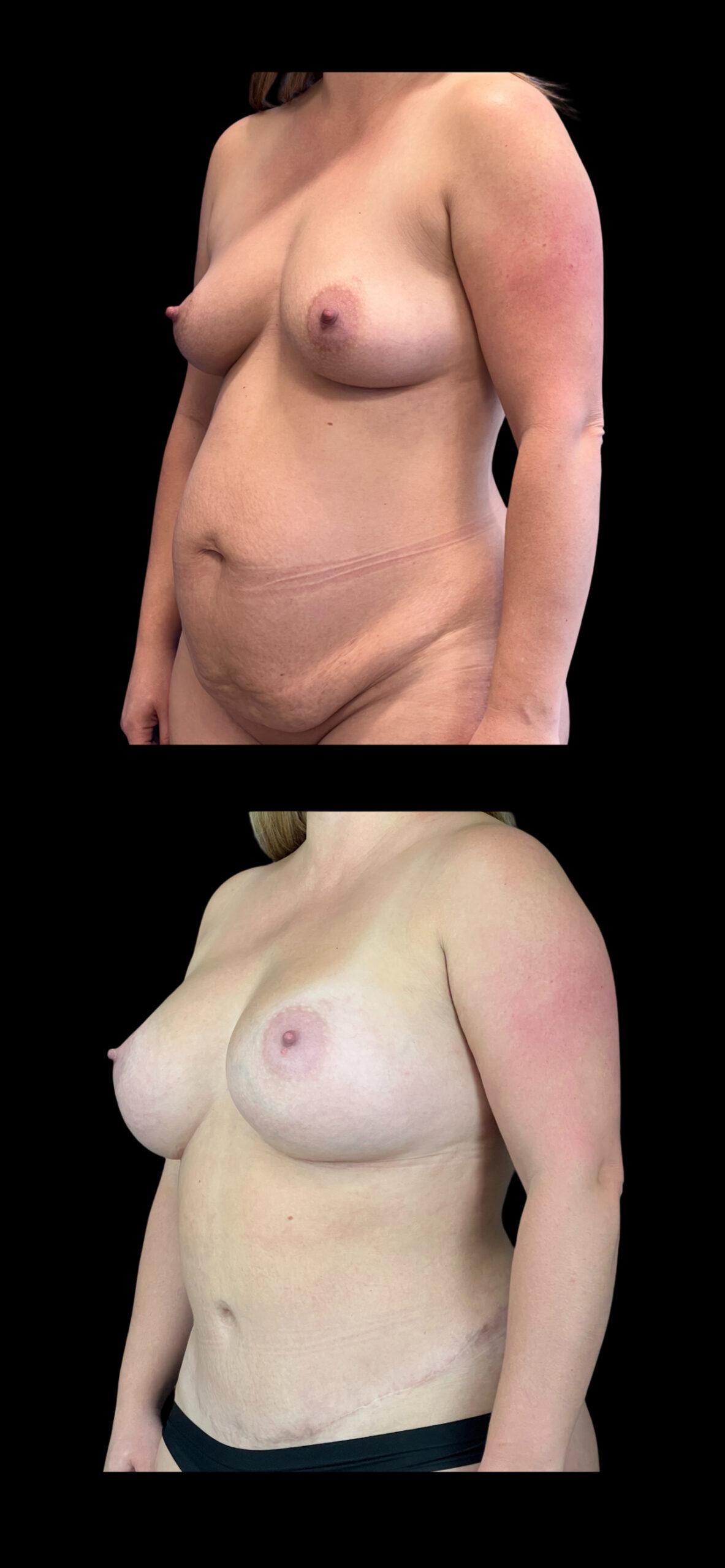PEAK PLASTIC SURGERY tummy tuck result — Salt Lake City, UT