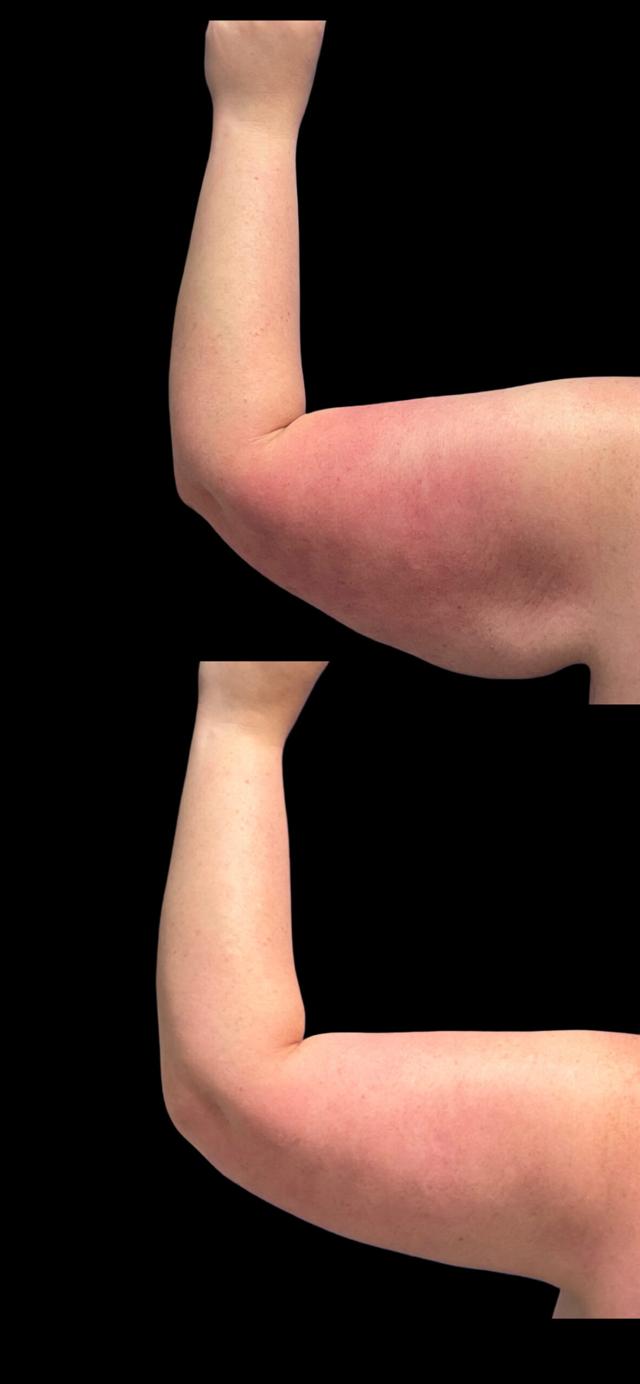 Arm Lift result at PEAK PLASTIC SURGERY in Salt Lake City, UT