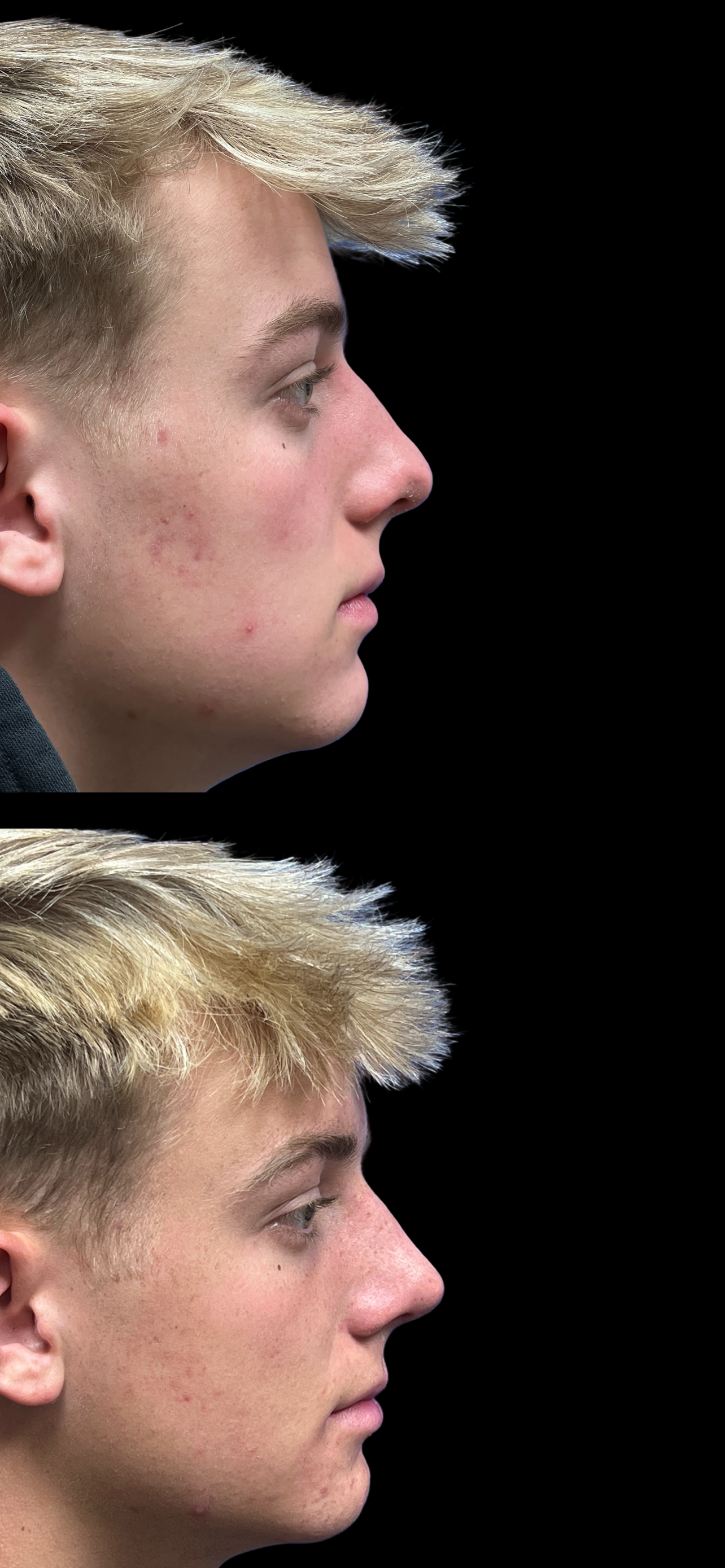 PEAK PLASTIC SURGERY rhinoplasty result — Draper, UT