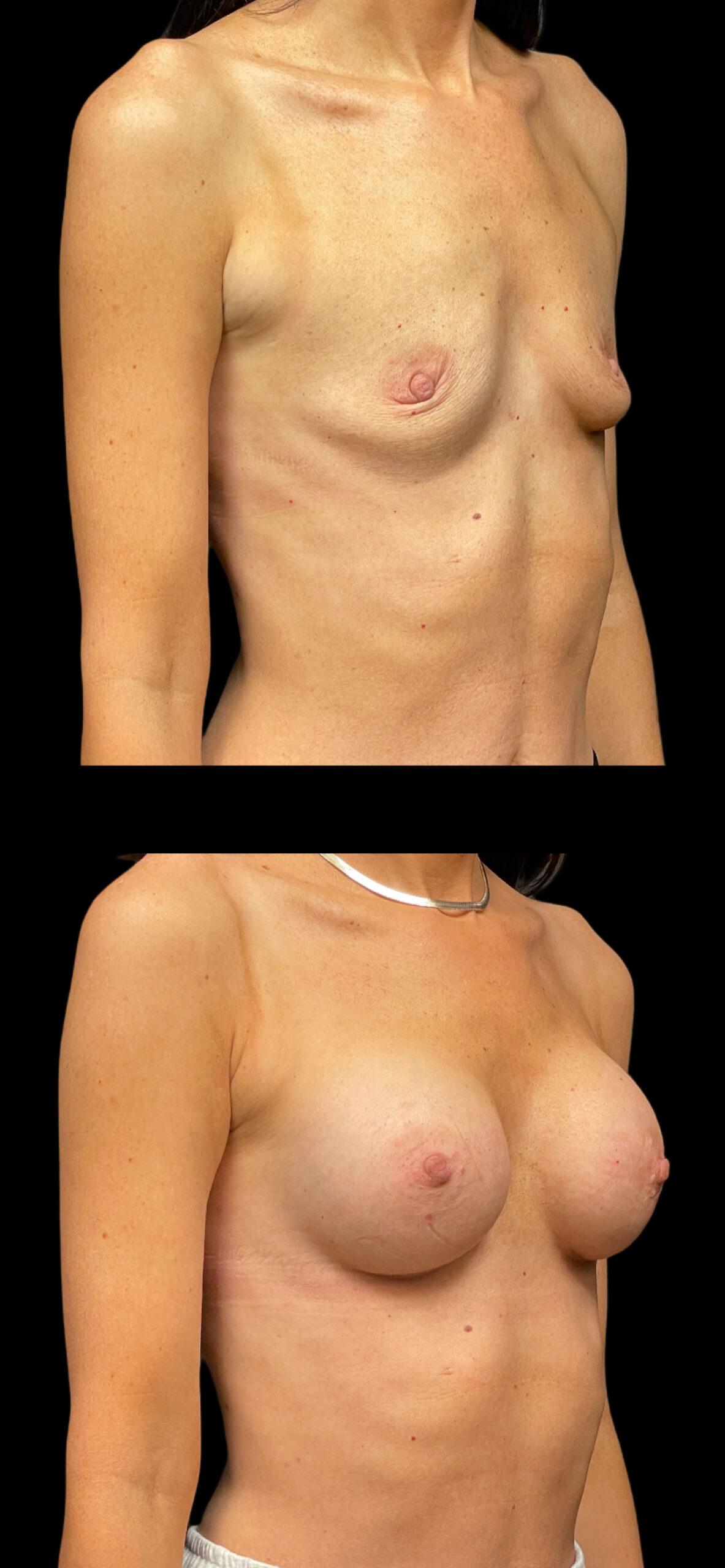 PEAK PLASTIC SURGERY breast augmentation result — Draper, UT