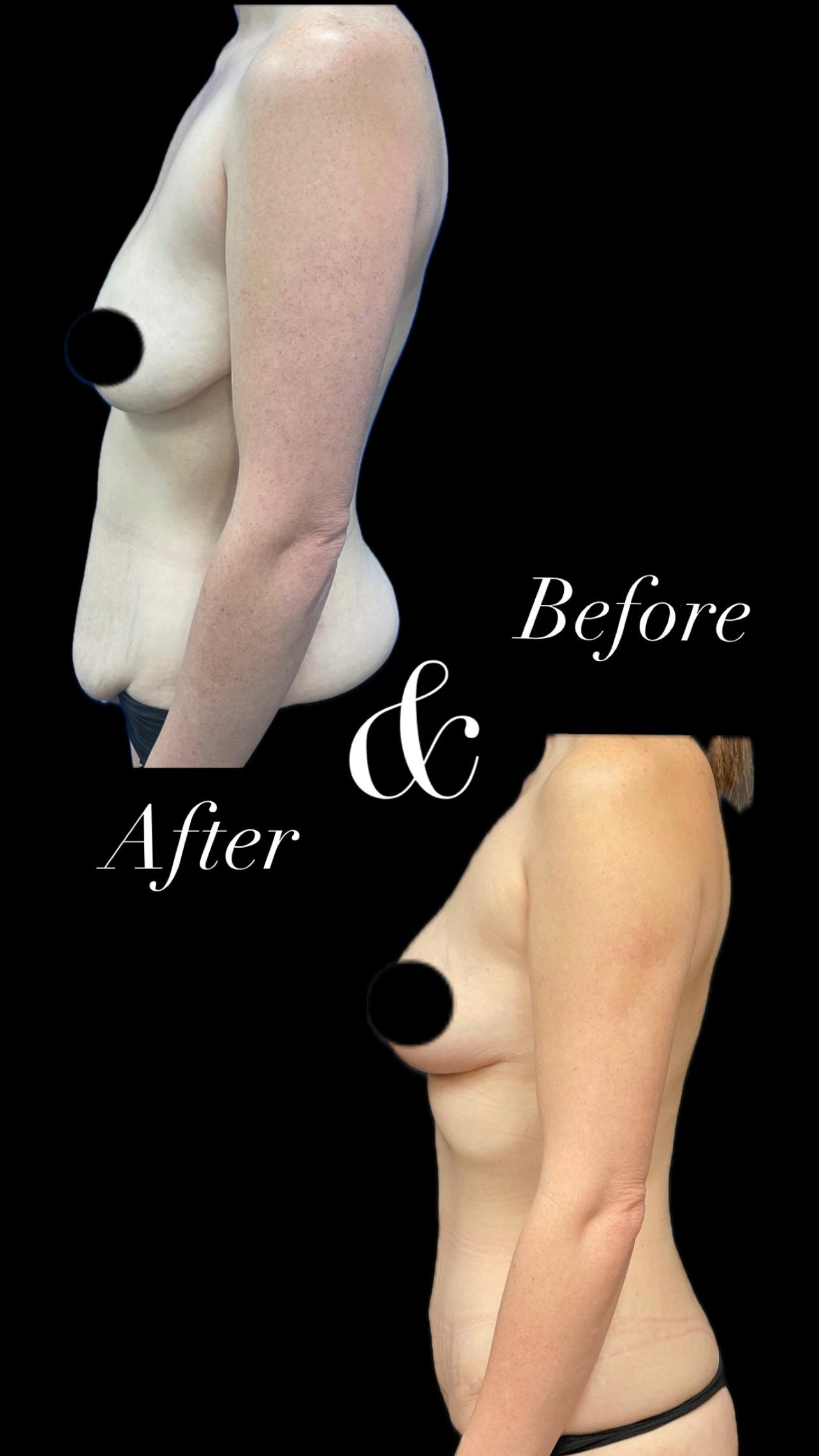 PEAK PLASTIC SURGERY tummy tuck result — Salt Lake City, UT
