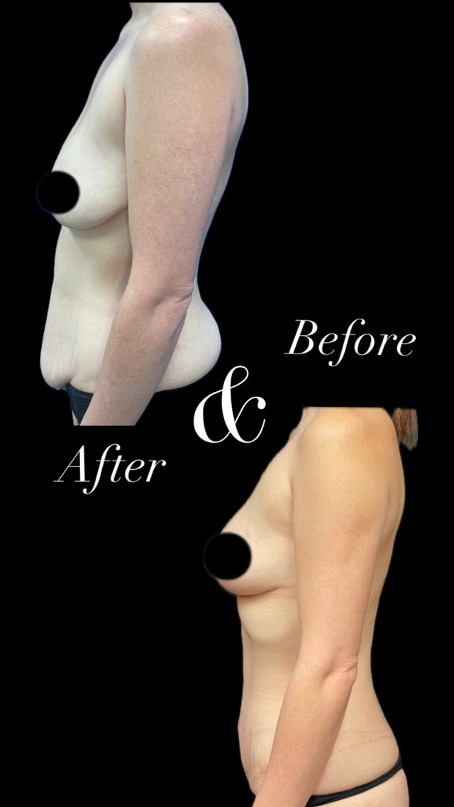 Tummy Tuck result at PEAK PLASTIC SURGERY in Draper, UT