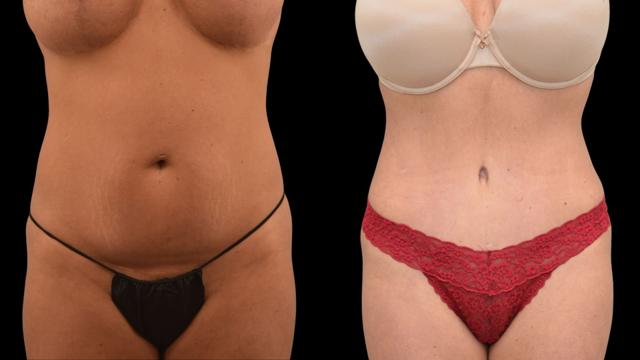 Tummy Tuck result at The Plastics Atelier in Omaha, NE