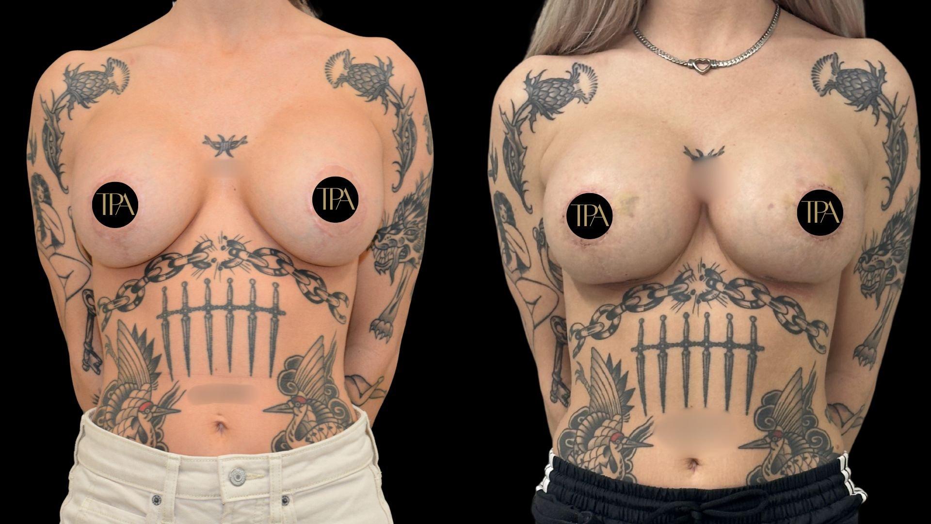 The Plastics Atelier implant revision result — Omaha, NE
