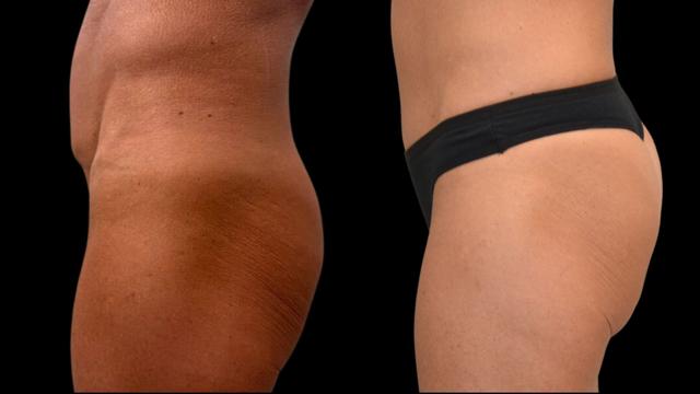 Brazilian Butt Lift result at The Plastics Atelier in Omaha, NE