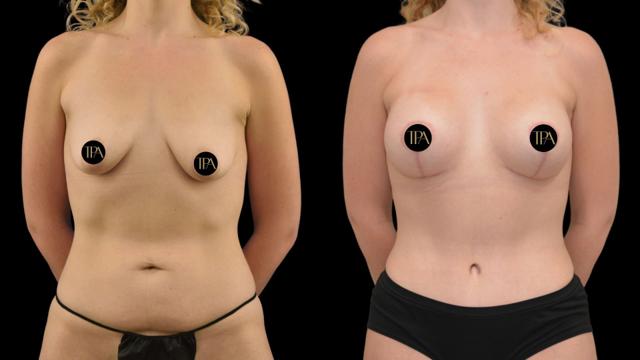 Breast Lift result at The Plastics Atelier in Omaha, NE