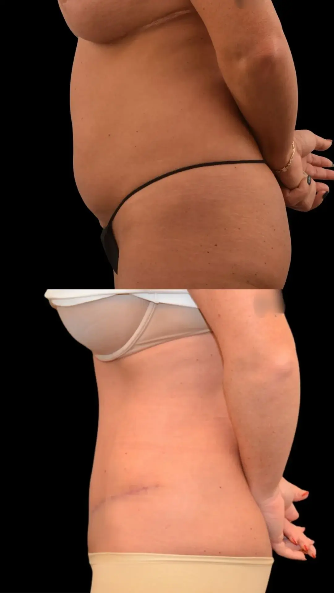 The Plastics Atelier tummy tuck result — Omaha, NE